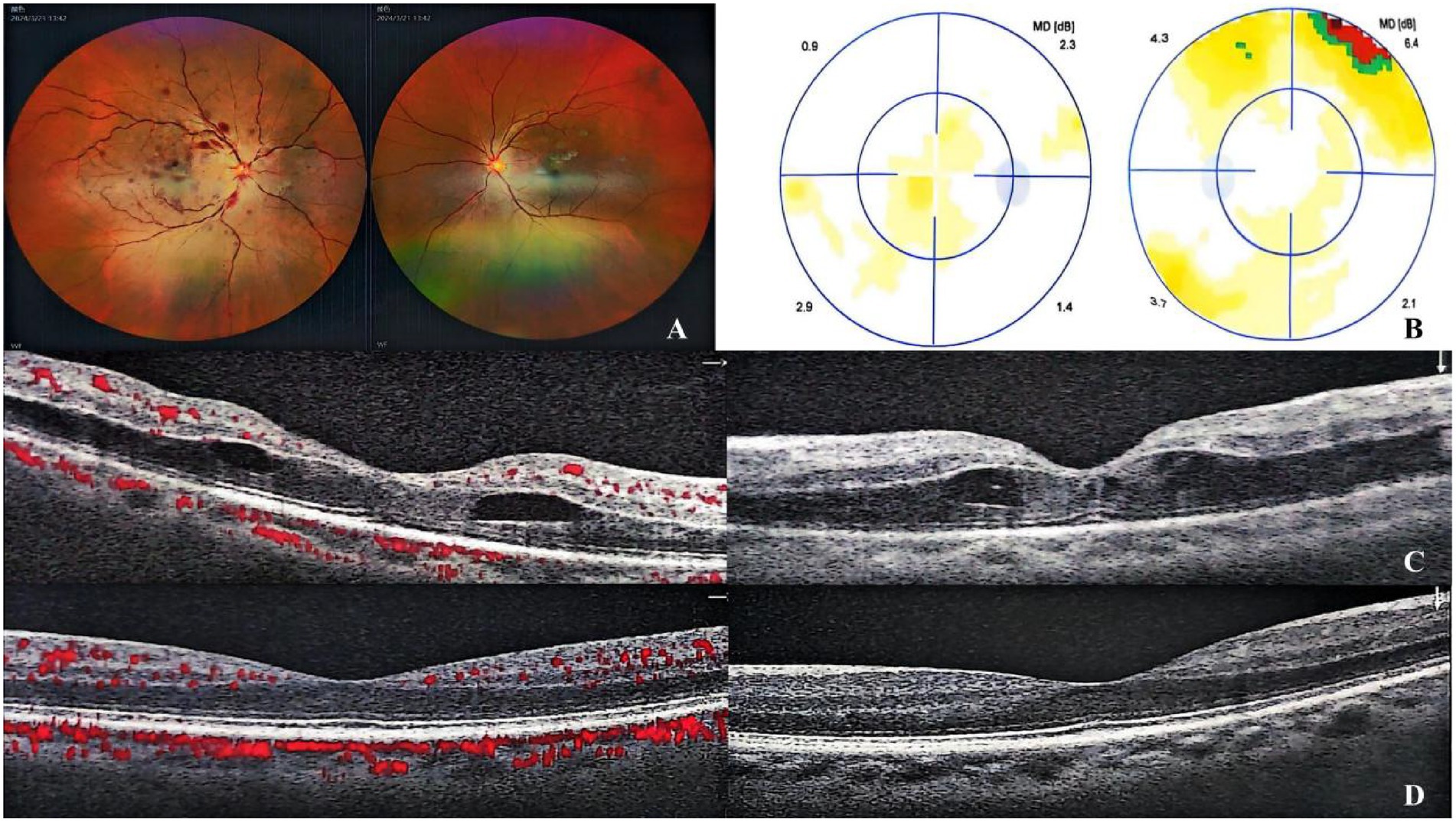 Fundus photography of right eye (Panel A) displays tortuous dilated veins, attenuated arteries, and scattered hemorrhages (dot/blot and flame-shaped). Panel B shows normal visual field test results. Panel C (OCTA) reveals macular edema with vascular anomalies. Panel D confirms left eye's normal retinal structure.
