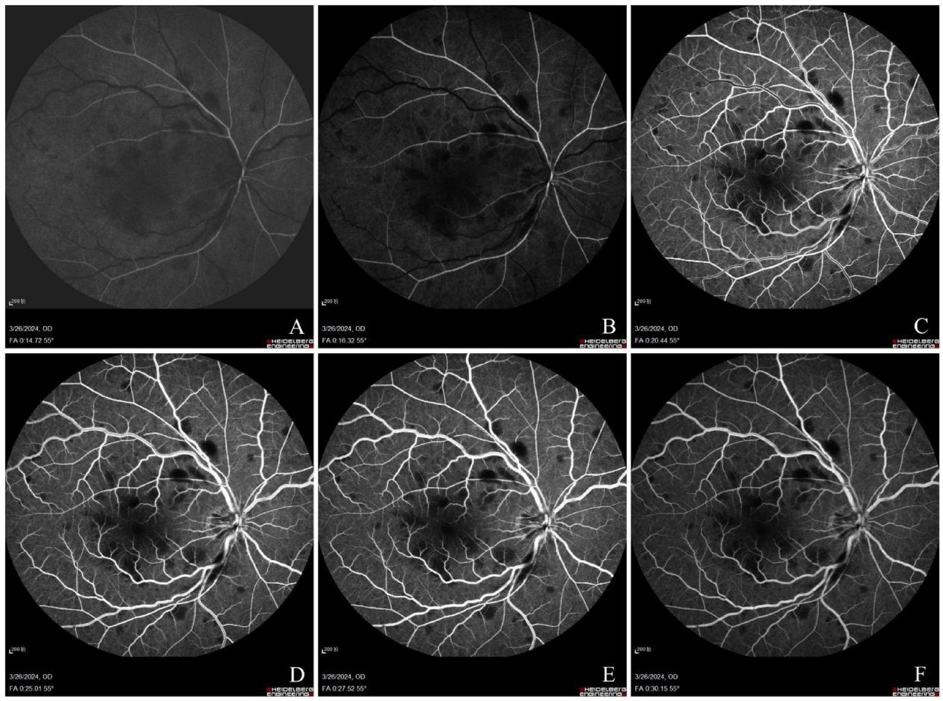Fluorescein angiography sequences (Panels A-F): Arterial phase (A) shows delayed arteriolar filling; early venous phase (B) demonstrates delayed venous drainage. Venous phase (C-E) reveals tortuous veins, non-perfusion areas, and hemorrhages. Late phase (F) exhibits mild macular leakage.