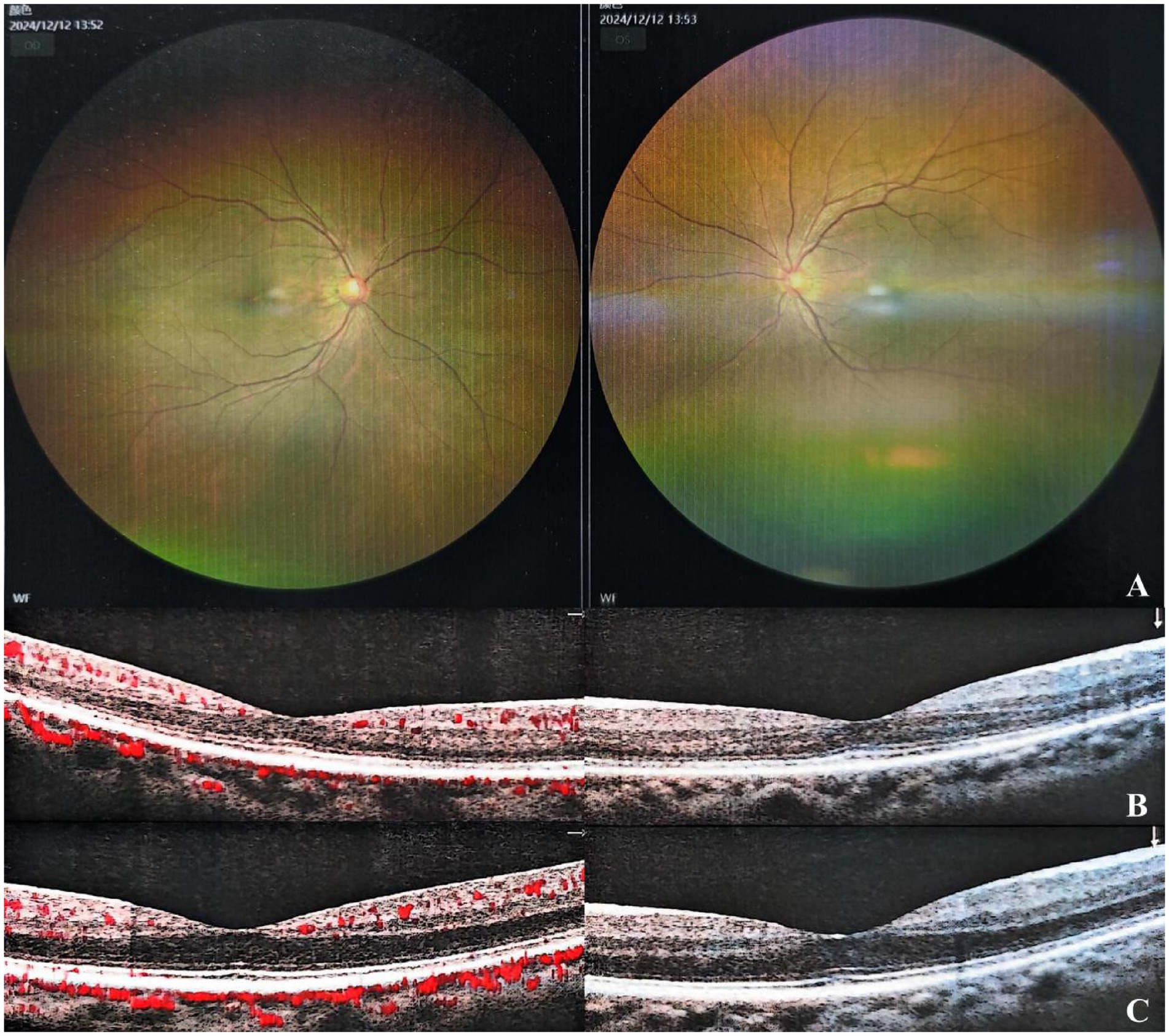 Final evaluation: Panel A reveals normal fundus bilaterally. Panels B-C (OCTA) show symmetrical retinal vasculature without pathology in both eyes.
