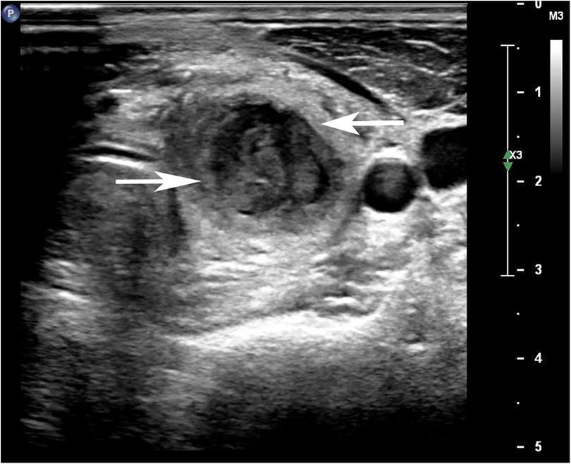 An ultrasound image of the thyroid gland showing an enlarged left lobe with an ill-defined hypoechoic lesion and internal septations. The lesion appears heterogeneous and irregular. A measurement scale is present on the right side.