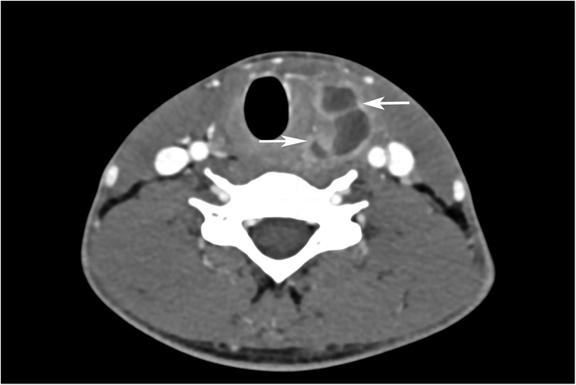 Contrast-enhanced axial CT image of the neck showing the enlarged left thyroid lobe with a hypodense lesion demonstrating peripheral enhancement and internal enhancing septae, consistent with a suppurative abscess. The trachea and cervical vertebrae are visible.