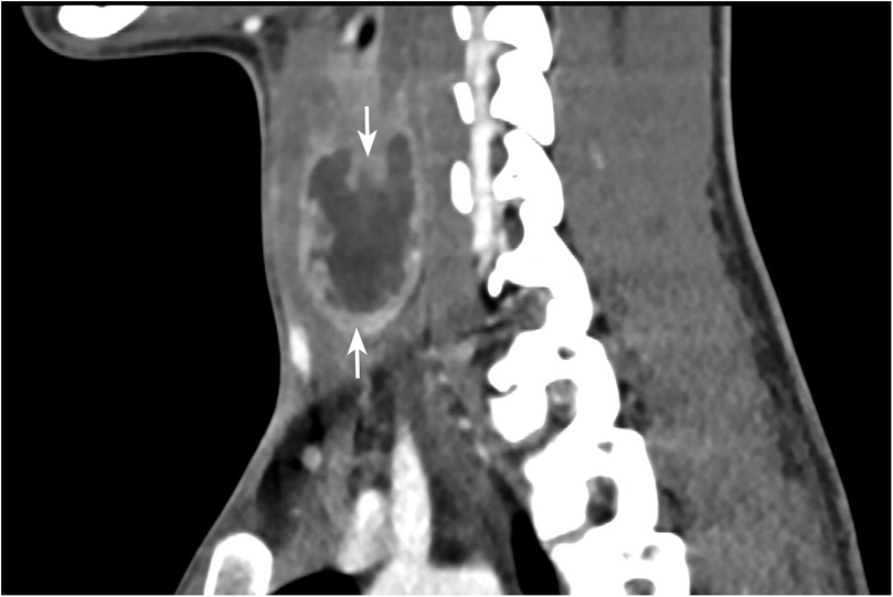 Coronal contrast-enhanced CT image showing the enlarged left thyroid lobe with a hypodense lesion, predominantly peripherally enhanced, with few internal enhancing septae, consistent with an abscess extending into surrounding soft tissue.