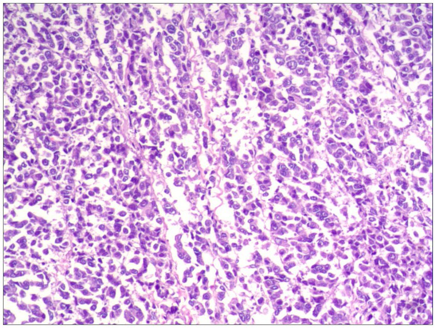 Microscopic view of tissue showing densely packed cells with dark purple nuclei, characteristic of a cancerous tumor. The staining highlights cellular morphology and crowded arrangement.