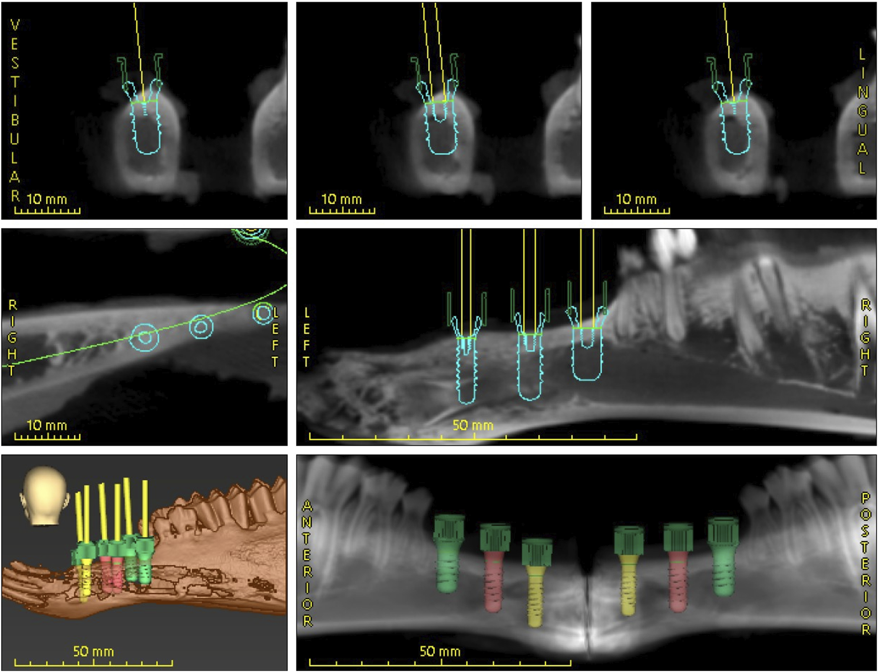 CBCT scan images show dental implants and jaw anatomy from various angles. The top row illustrates different cross-sectional views of implants with highlighted outlines. The middle row includes longitudinal views, indicating implant position along the jaw. The bottom left image provides a 3D model with implant placements, and the bottom right shows an anterior-posterior view highlighting implant locations. Each image includes measurement scales and directional labels for reference.