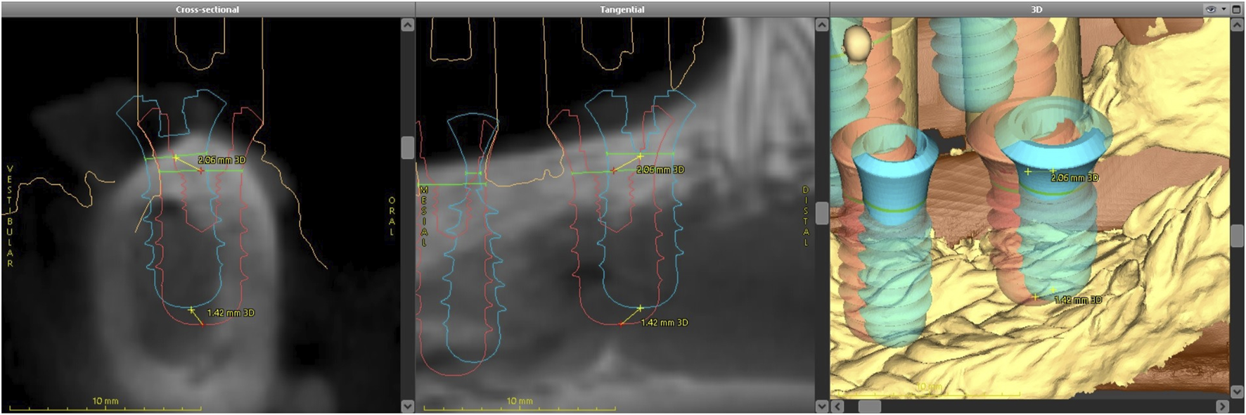 Dental imaging shows a cross-sectional, tangential, and 3D view of dental implants. Measurements indicate distances between points, with emphasis on dimensions and positioning. The 3D model shows dental implants.