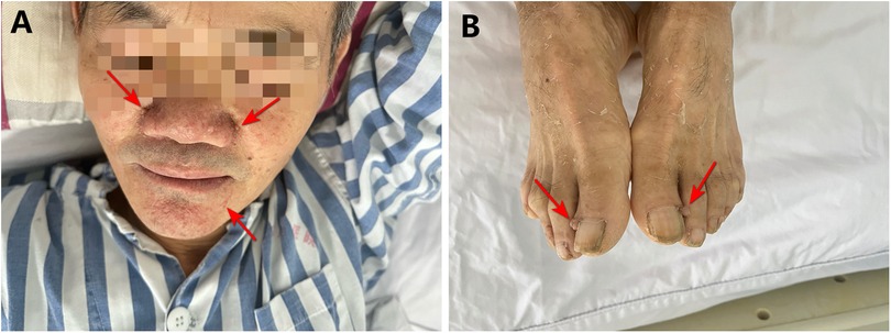 Panel A shows a close-up of a person's face with red arrows indicating specific areas on the cheeks and chin. Panel B displays the tops of a person's feet with red arrows pointing to particular toes. The person is wearing striped clothing.