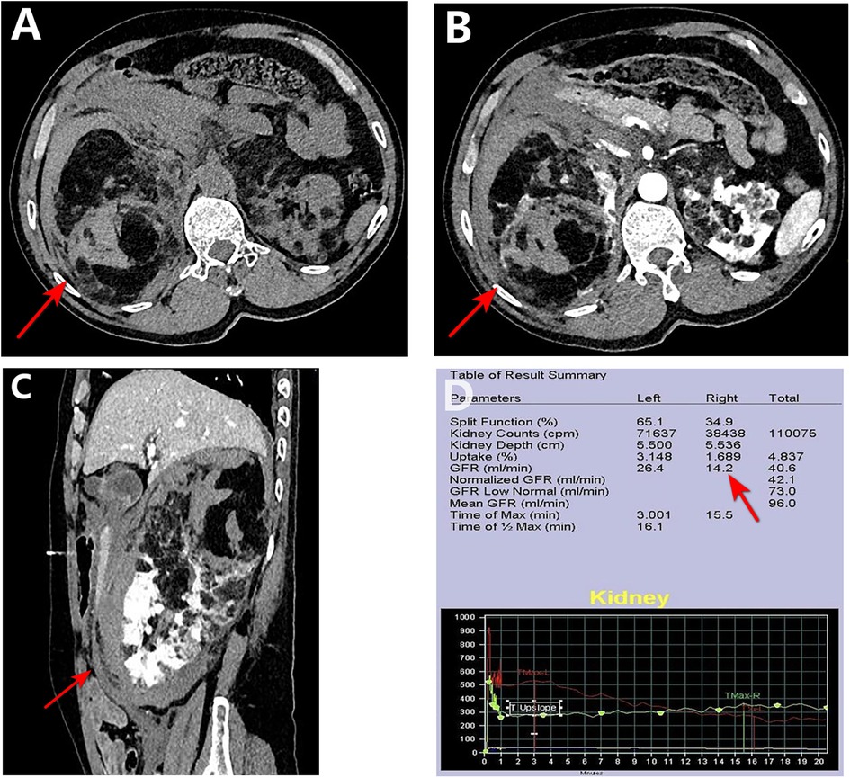 CT images and diagnostic data are displayed. Image A shows a cross-section of the abdomen with a red arrow indicating a specific area. Image B is a similar cross-section with another red arrow. Image C presents a sagittal view with an arrow pointing at a distinct feature. A table summarizes renal function parameters, including kidney counts, depth, uptake percentage, GFR values, and times of maximum activity. Below the table, a graph labeled \