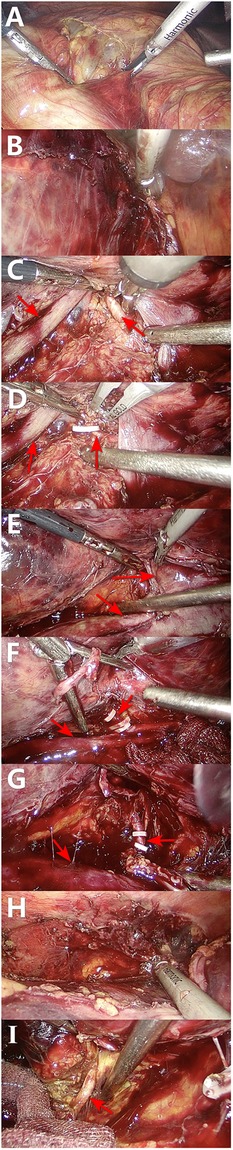 Series of surgical procedure images labeled A to I, showcasing different stages of tissue manipulation and exposure. Surgical tools are visible, including a harmonic scalpel. Tissue layers are separated and vessels are indicated by red arrows. Various clips and instruments are used to secure and isolate structures. Each panel highlights specific surgical details and steps.