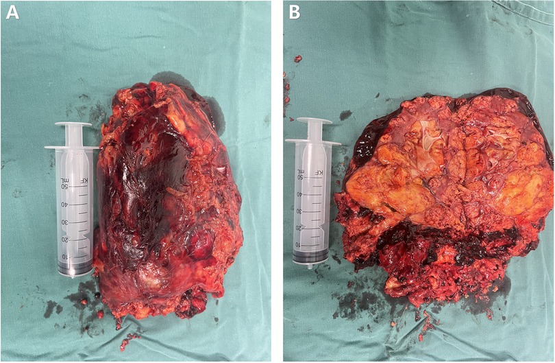 Panels A and B show two excised tissue masses placed on a green surgical drape. Each mass is dark red, with varying textures and colors. A syringe is placed next to each mass for scale comparison.