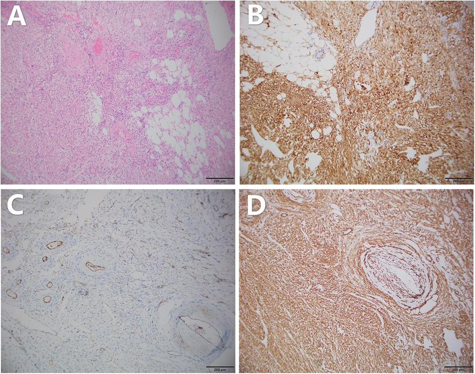Microscopic images of tissue sections labeled A to D. Image A shows a pink-stained section, possibly H&E, with varied cell structures. Image B features dense, brown-stained areas indicating specific marker expression. Image C has light staining with outlined structures, suggesting minimal marker presence. Image D displays intense brown staining with distinct circular formations, indicating strong marker expression. Each image includes a scale bar of 200 micrometers.