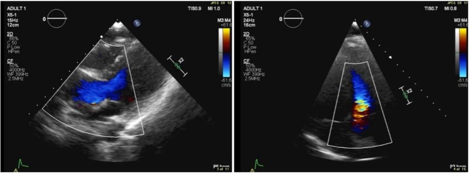 Two ultrasound Doppler images show color flow mapping. The left image displays a region with blue and red indicating direction of blood flow. The right image similarly shows blood flow with blue and red hues, suggesting velocity and direction changes.