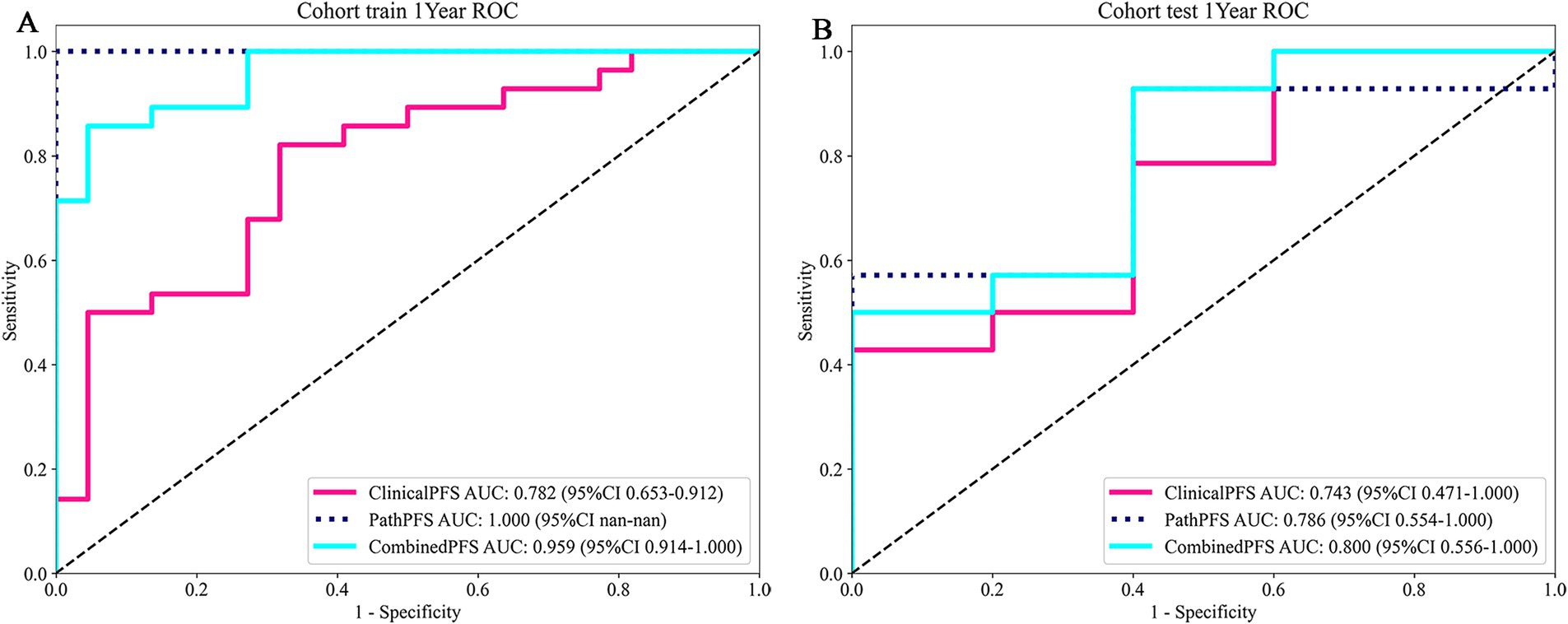 Two ROC curve plots labeled A and B display sensitivity versus 1-specificity. In plot A, ClinicalPFS has an AUC of 0.782, PathPFS has an AUC of 1.000, and CombinedPFS has an AUC of 0.959. In plot B, ClinicalPFS has an AUC of 0.743, PathPFS has an AUC of 0.786, and CombinedPFS has an AUC of 0.800. Each plot includes three lines representing these metrics.