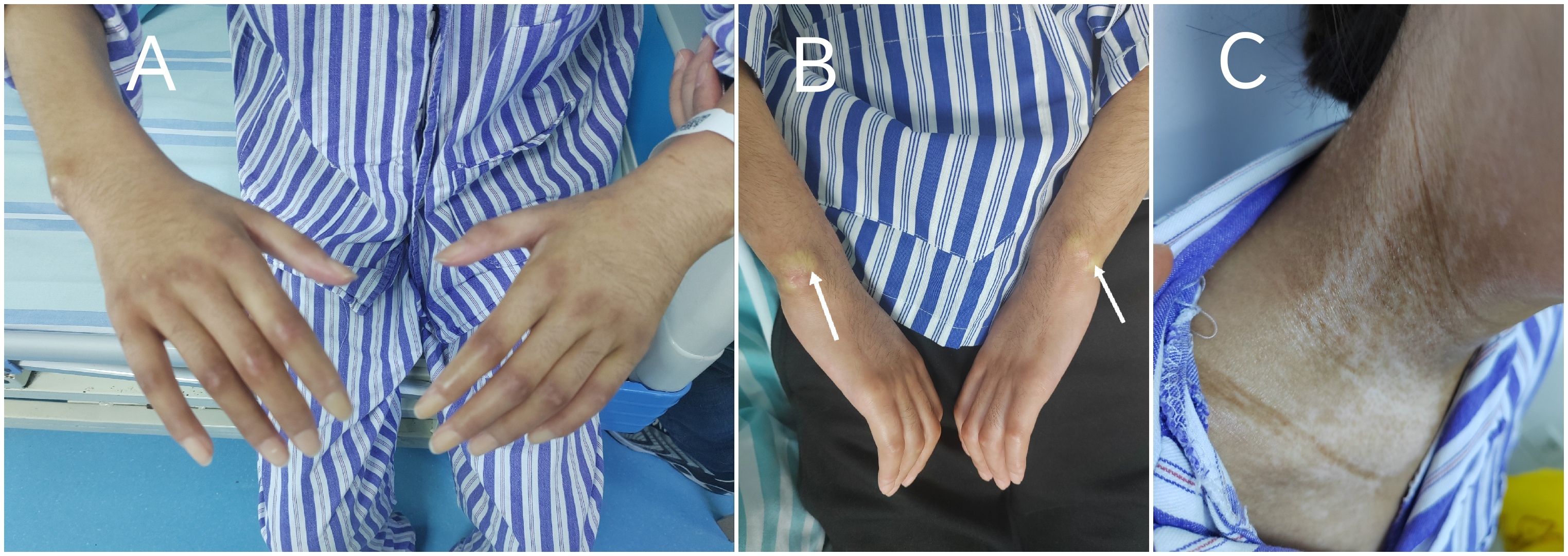 A three-part image showing hands and a neck. Image A displays two hands in a relaxed position. Image B shows the forearms with yellowish discoloration and arrows indicating specific areas. Image C focuses on a neck with discoloration and textured skin. The person is wearing blue and white striped clothing.