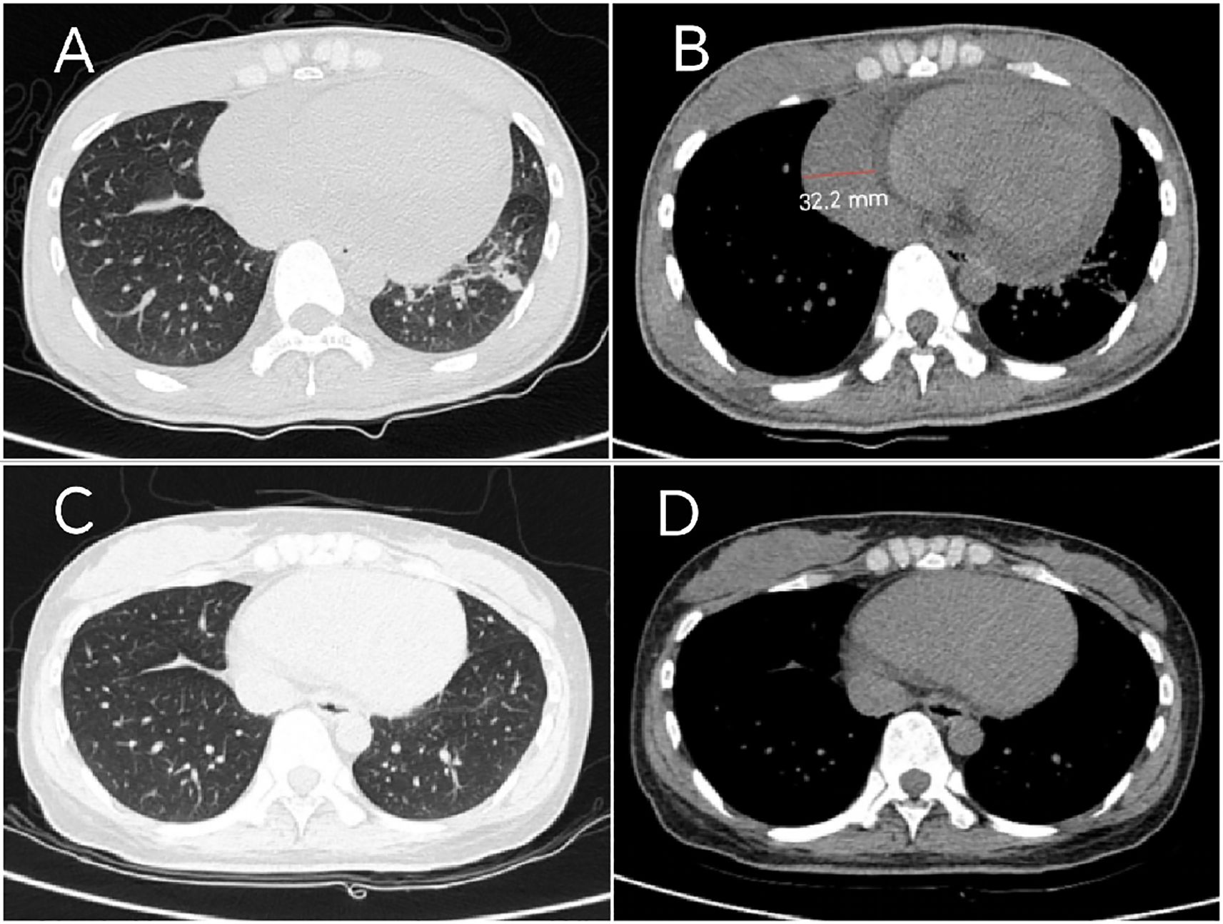 Four-panel CT scan images labeled A to D showing thoracic cross-sections. Image A shows clear lung fields. Image B highlights a heart measurement of 32.2 millimeters. Image C shows clarity similar to A, while D depicts denser structures akin to B.