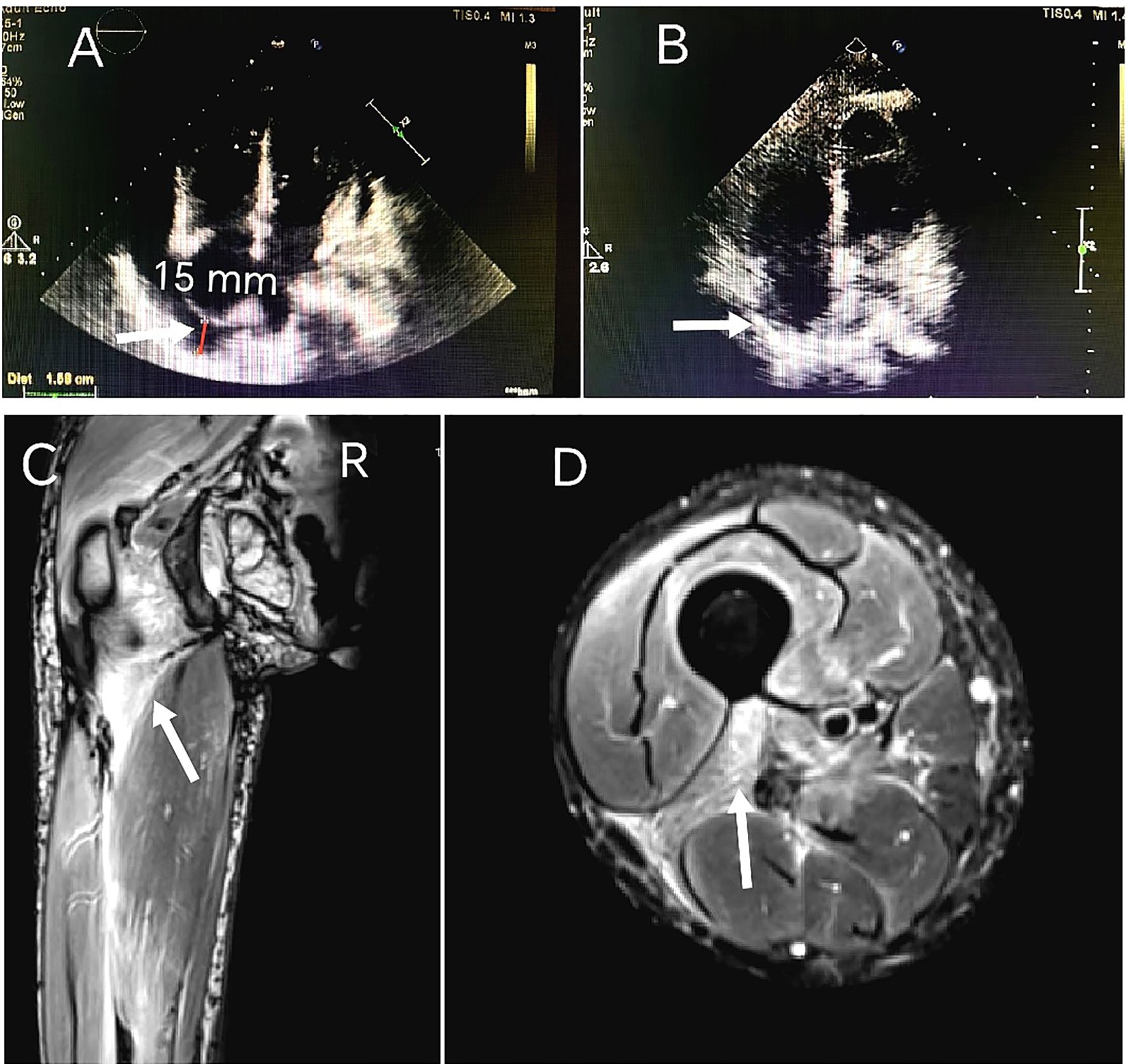 Ultrasound and MRI images demonstrating medical conditions. Panel A shows an ultrasound measurement labeled 15 mm. Panel B features another ultrasound image. Panel C portrays an MRI sagittal slice with a focus on the knee. Panel D displays a transverse MRI section highlighting leg muscle structure. White arrows point to specific areas of interest in each image.