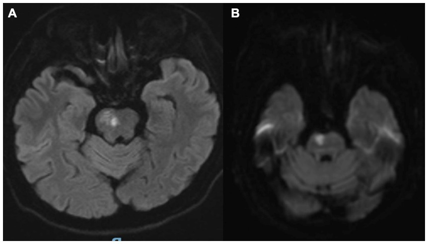 MRI brain scans with two panels. Image A shows a transverse section with clear differentiation of brain structures. Image B, also a transverse section, appears darker, with less detail visible.