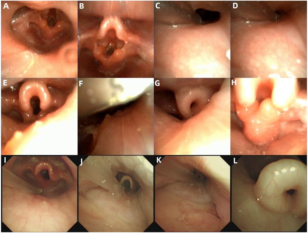 A series of twelve images labeled A to L, showing close-up endoscopic views of the human airway. Each image presents different angles and sections of the larynx and trachea, highlighting the variations in structure and appearance of the mucosal surfaces and cartilage. The images display healthy, detailed anatomical features typical in medical examinations.
