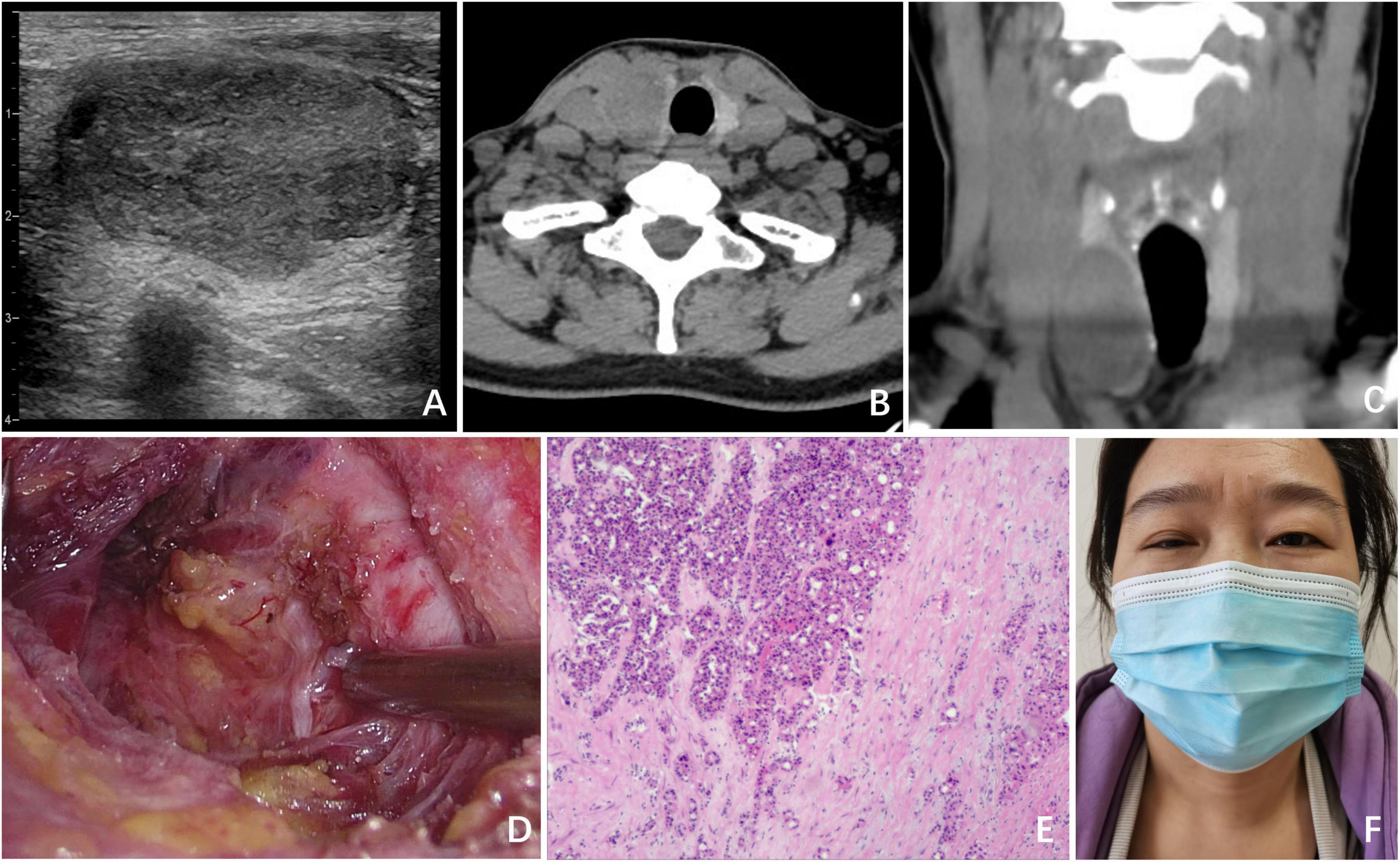 A collage of six images labeled A to F. Image A: Ultrasound of a neck region showing an irregular mass. Image B: Axial CT scan with a similar mass. Image C: Coronal CT scan showing the mass’s vertical extent. Image D: Intraoperative view of the surgical area exposing tissue. Image E: Histological section under a microscope displaying cellular detail. Image F: A person wearing a blue surgical mask.