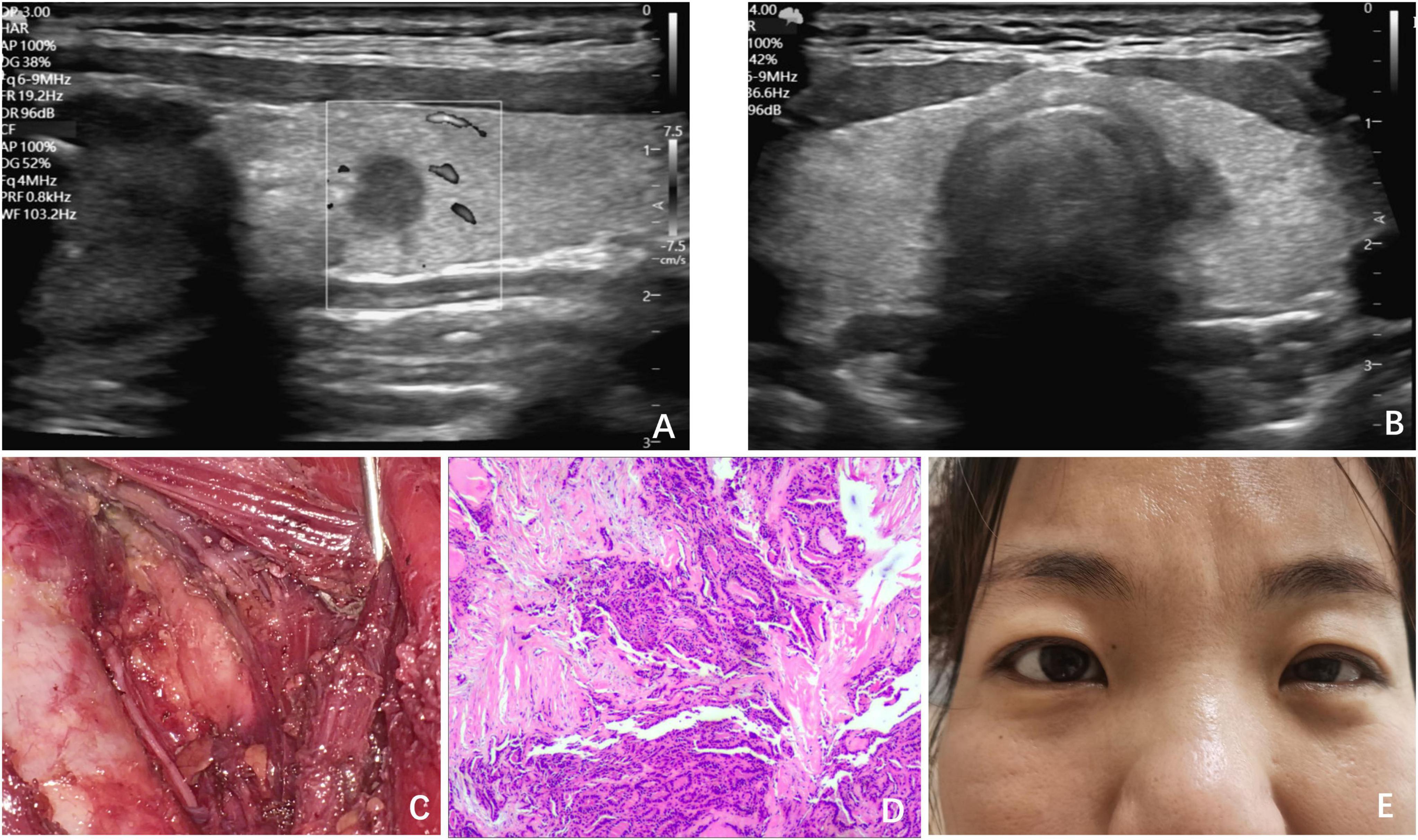 Ultrasound image A shows a thyroid lesion with microcalcifications. Image B displays a large thyroid mass. Image C captures a surgical view of excised tissue. Image D is a histopathological section showing cellular details. Image E features a facial view of a person with no visible abnormalities in the eye region.