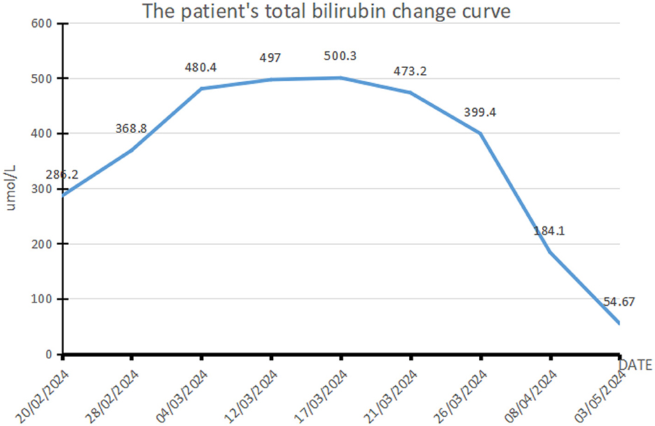Line graph showing a patient's total bilirubin levels over time from 20/02/2024 to 03/05/2024. Levels rise from 286.2 to a peak of 500.3 μ mol/L on 17/03/2024, then decline to 54.67 μ mol/L by 03/05/2024.