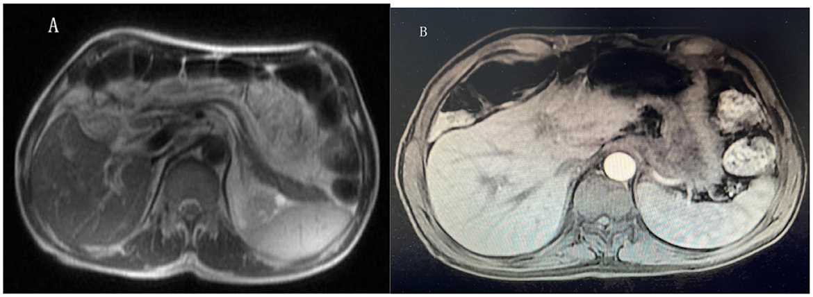 MRI scans of a human abdomen in two panels. Panel A shows a cross-sectional view with clear organ outlines and varied tissue densities. Panel B displays another cross-section with different contrast, highlighting areas of interest in the abdomen.