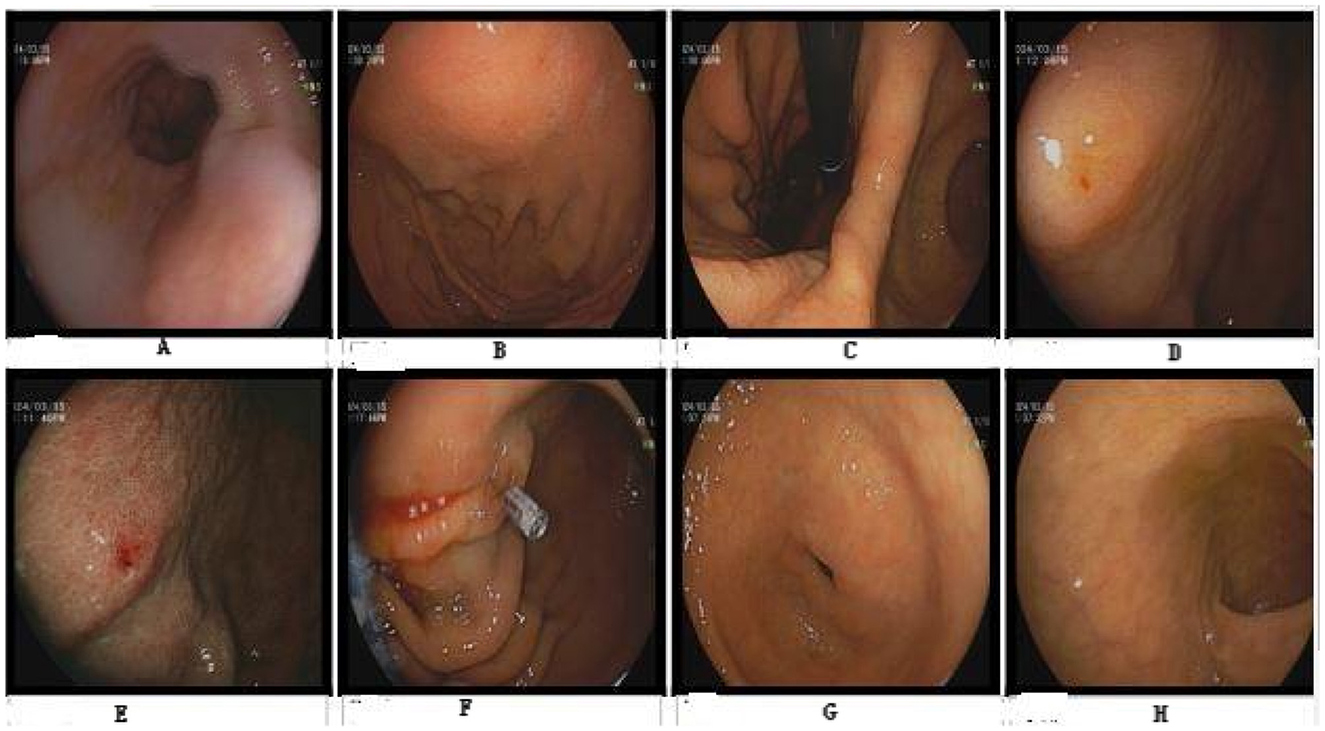 A series of eight endoscopic images labeled A to H. Each image shows different sections of the gastrointestinal tract with varying levels of detail and coloration. Some images display smooth mucosal surfaces, while others reveal slight inflammation, lesions, or substances adhering to the walls. A specific procedure tool is visible in image F. The images appear to document a medical examination or condition within the esophagus or intestines.