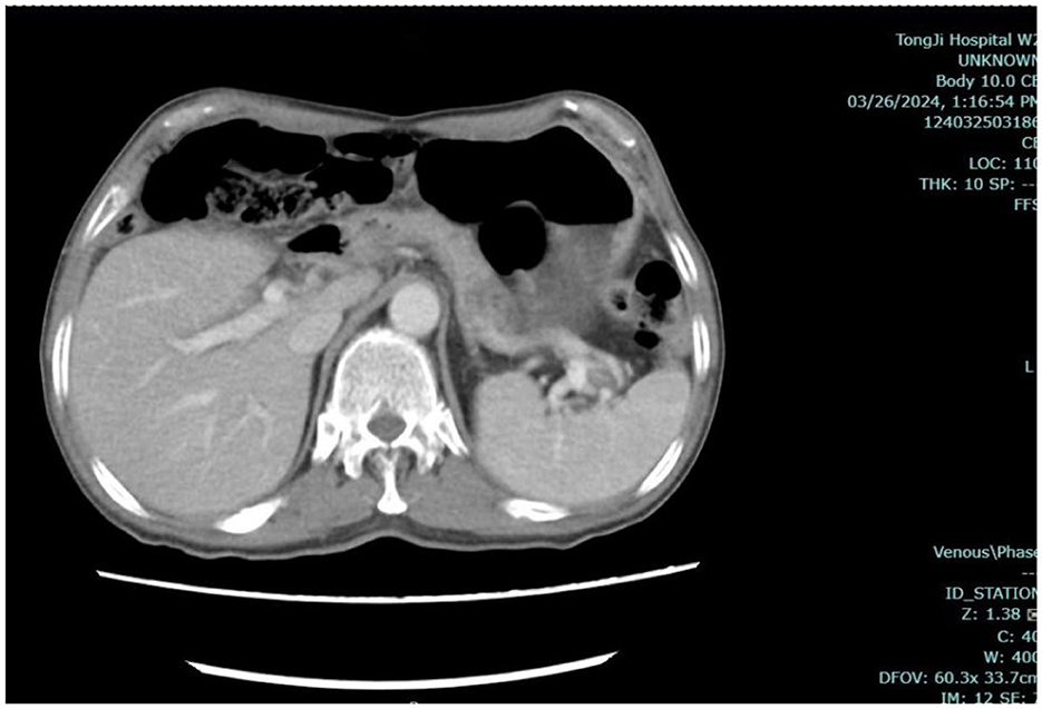 CT scan image showing a cross-sectional view of the abdominal region. Organs such as the liver, kidneys, and spine are visible. Text on the right provides details like hospital name, date, and technical parameters.