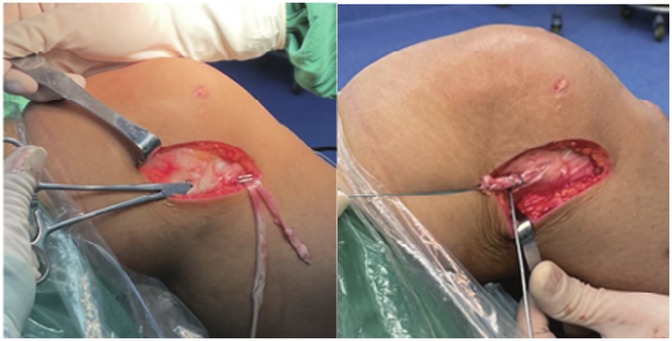 Surgical procedure involving an incision on the side of a knee, showing exposed tissue. Clamps and surgical tools are used to adjust the incision, with medical staff wearing gloves. The setting appears to be an operating room.