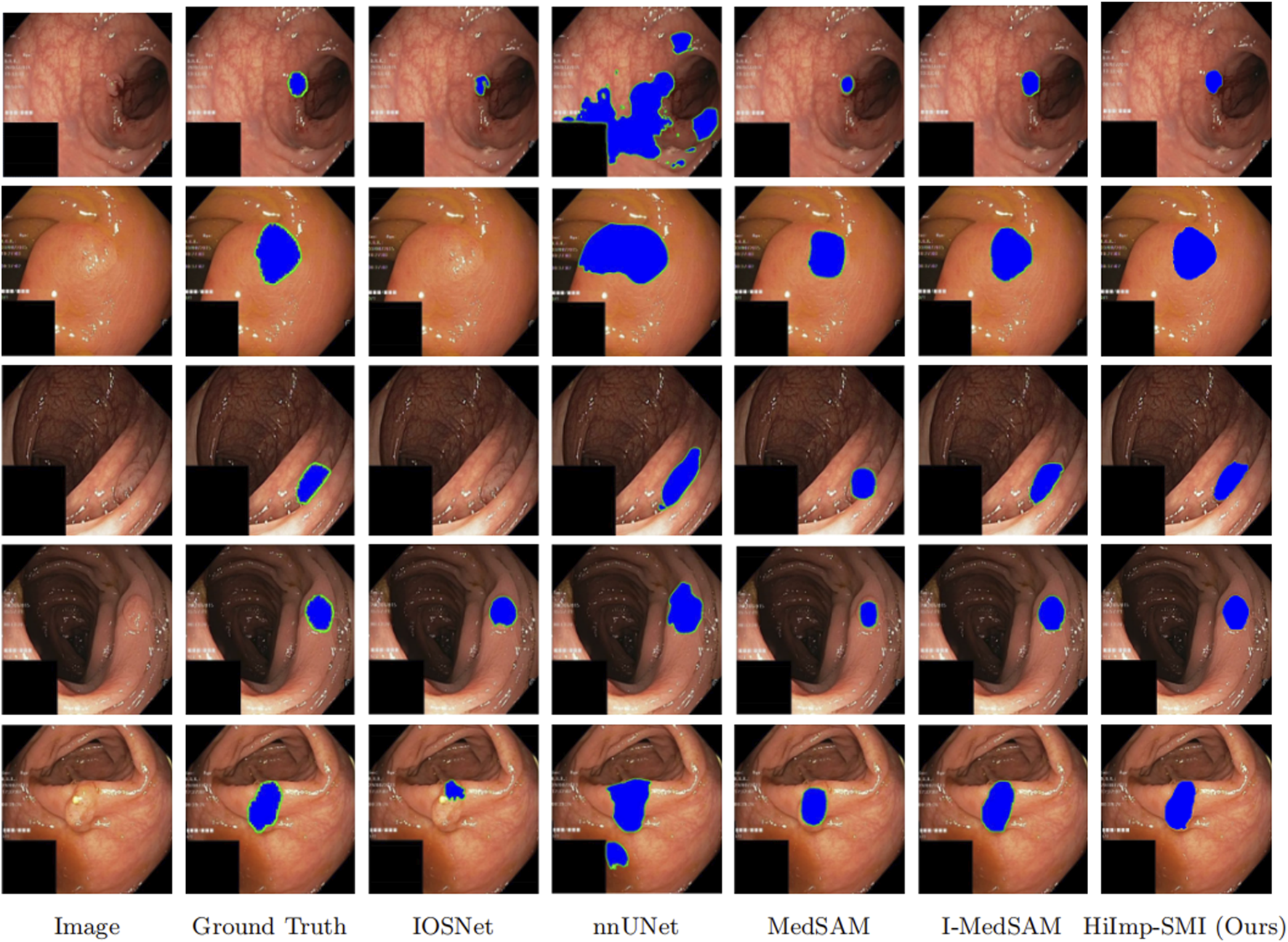 A grid of images showing colonoscopy results for segmentation methods comparison, including Ground Truth, IOSNet, nnUNet, MedSAM, I-MedSAM, and HiImp-SMI, with various highlighted areas for each approach.