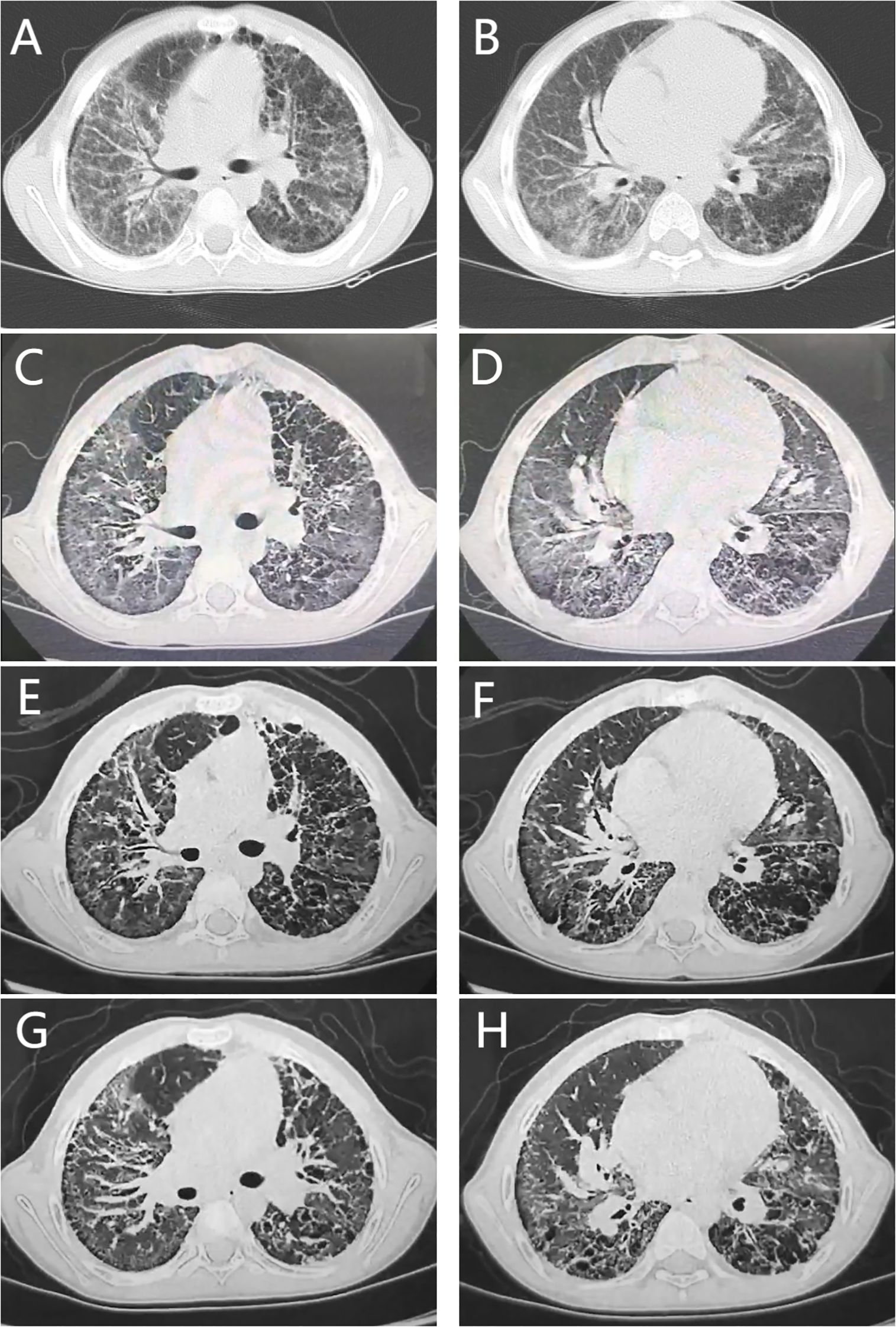 Two CT images were selected at each of four critical time points to reflect changes across multiple lung lobes at each stage of treatment. Panel A and B: before initiation of tofacitinib; Panel C and D: 1 year after tofacitinib; Panel E and F: 2 months after ruxolitinib; Panel G and H: 1 year after ruxolitinib.