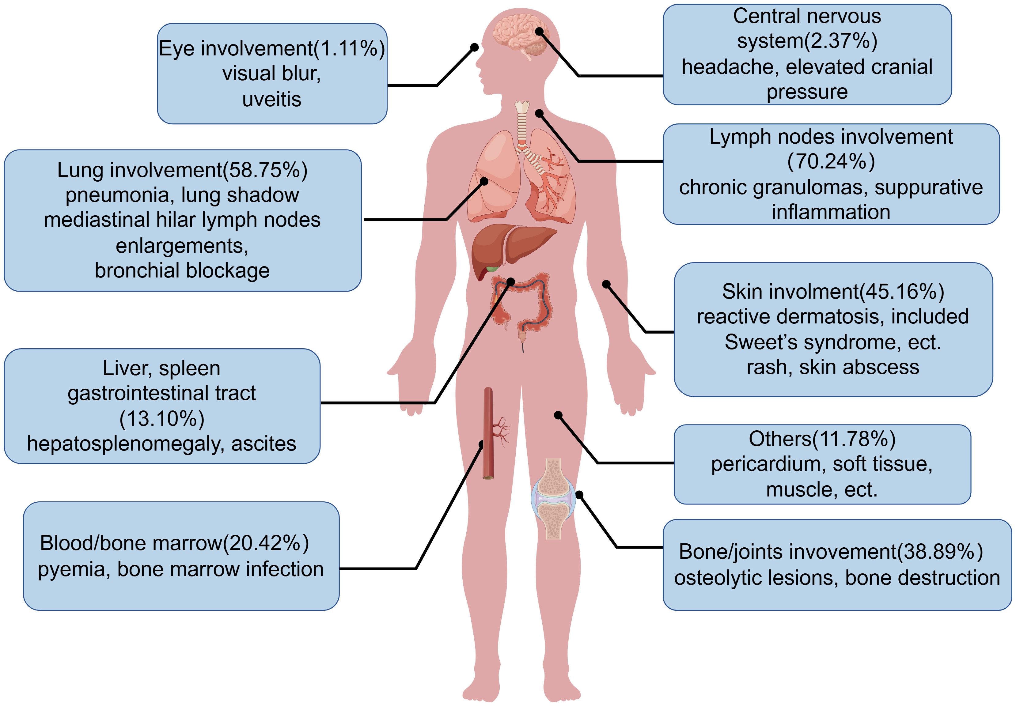 Diagram of a human body with various labeled health conditions. Eye involvement (1.11%) includes visual blur and uveitis. Lung involvement (58.75%) comprises pneumonia and bronchial blockage. The central nervous system (2.37%) is affected by headaches and elevated cranial pressure. Lymph node involvement (70.24%) includes chronic granulomas. Skin involvement (45.16%) features dermatosis and rashes. Liver and spleen issues (13.10%) include hepatosplenomegaly. Blood/bone marrow (20.42%) faces infections. Bone/joints (38.89%) suffer from lesions. Other areas (11.78%) include pericardium and soft tissue issues.