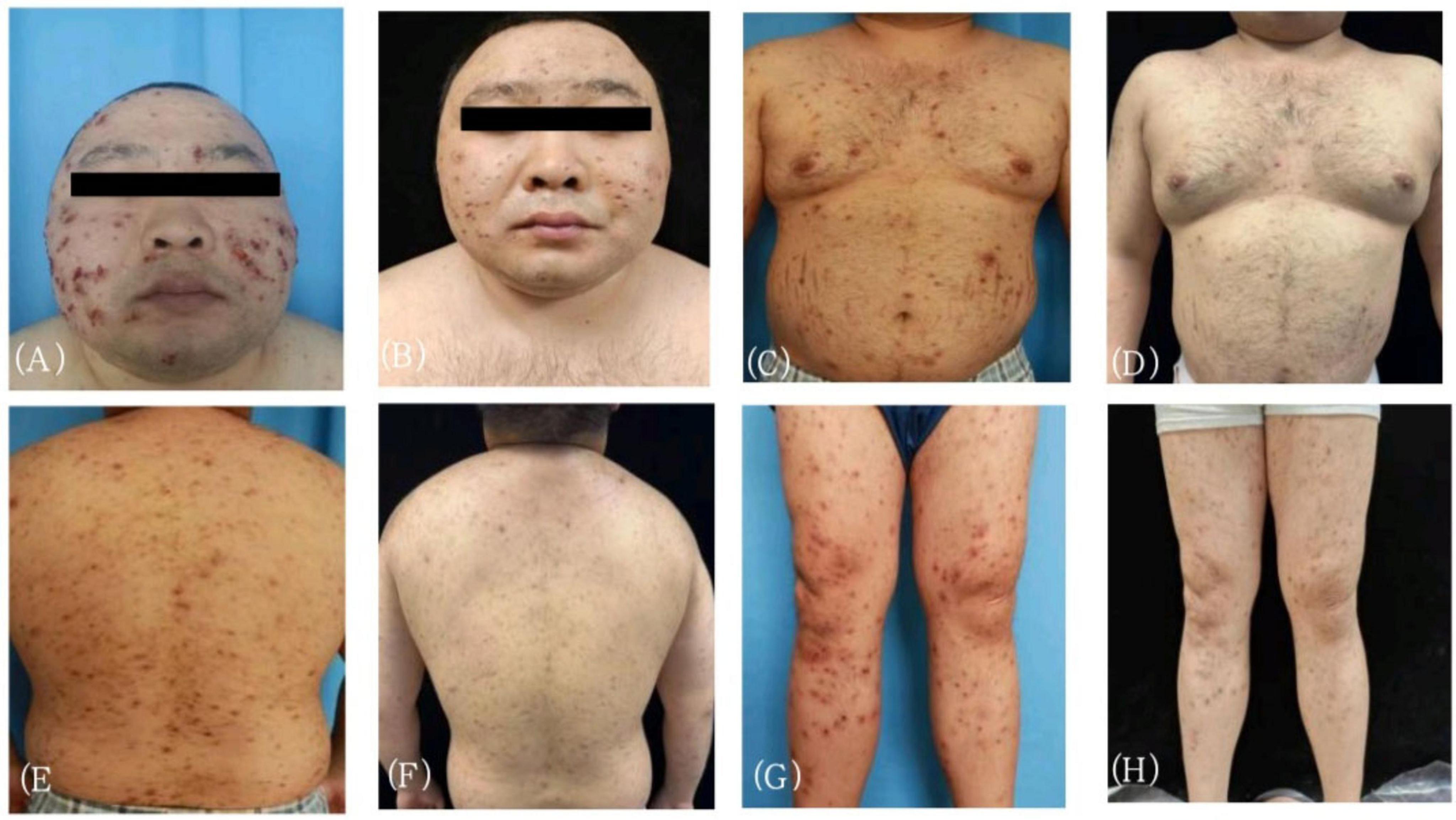 Eight images depict various views of a person’s body with skin conditions. Panels A and B show the face with lesions, A more pronounced than B. Panels C and D display the chest area with visible skin marks, C more severe. Panels E and F show the back, E with more lesions. Panels G and H focus on the legs, G showing numerous lesions compared to H.