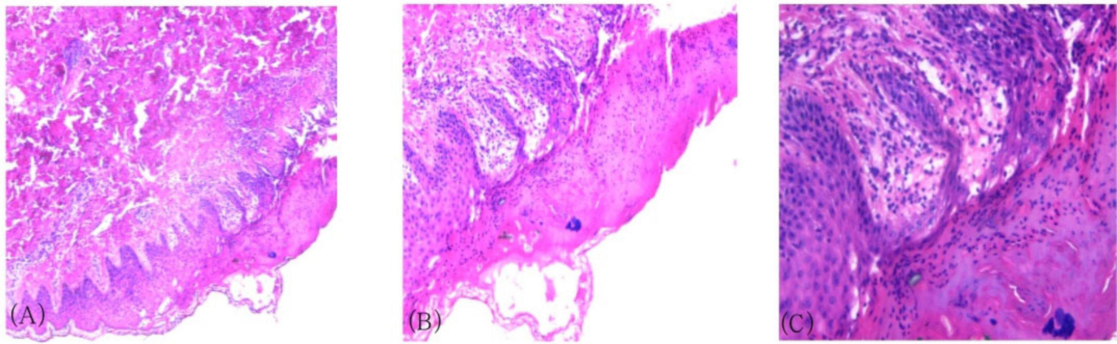 Histological slides show three panels labeled A, B, and C. Panel A displays a section of tissue with uniform, elongated papillae. Panel B shows a transition to irregular, broader structures. Panel C highlights densely packed cells with increased nuclear variation. All panels are stained with a pink and purple dye, commonly used in histology.
