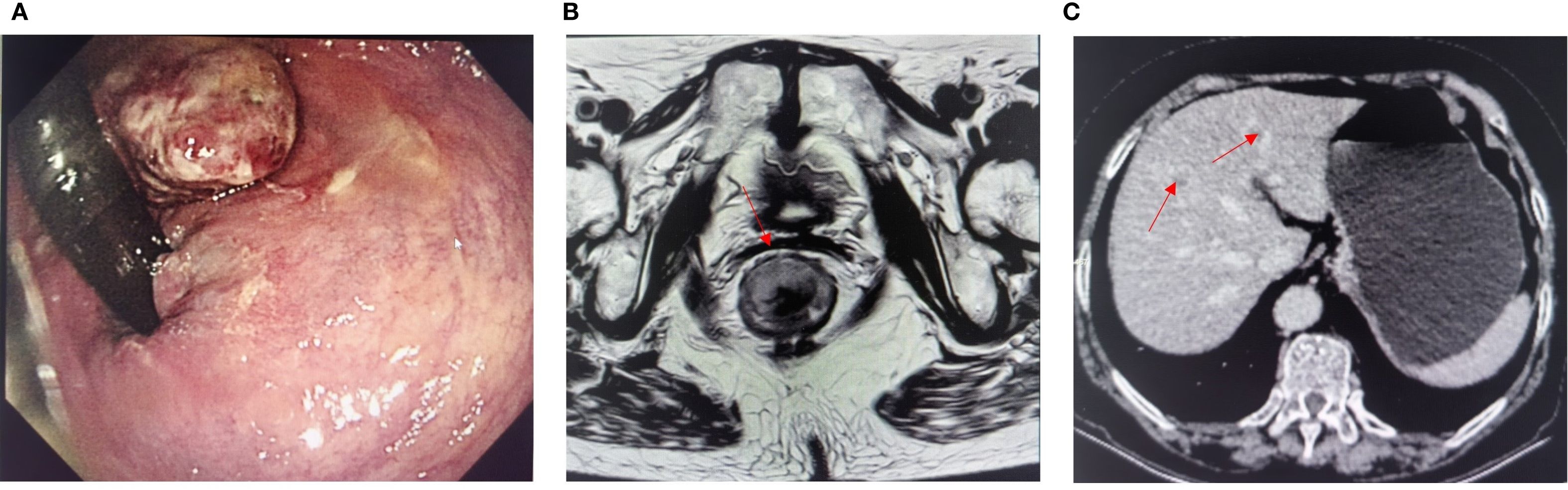 A) Endoscopic image showing a large polypoid lesion in the lining of the gastrointestinal tract. B) MRI scan highlighting a mass in the pelvic region with an arrow pointing to the location. C) CT scan of the abdomen displaying an enlarged organ with an arrow indicating a specific area of interest.