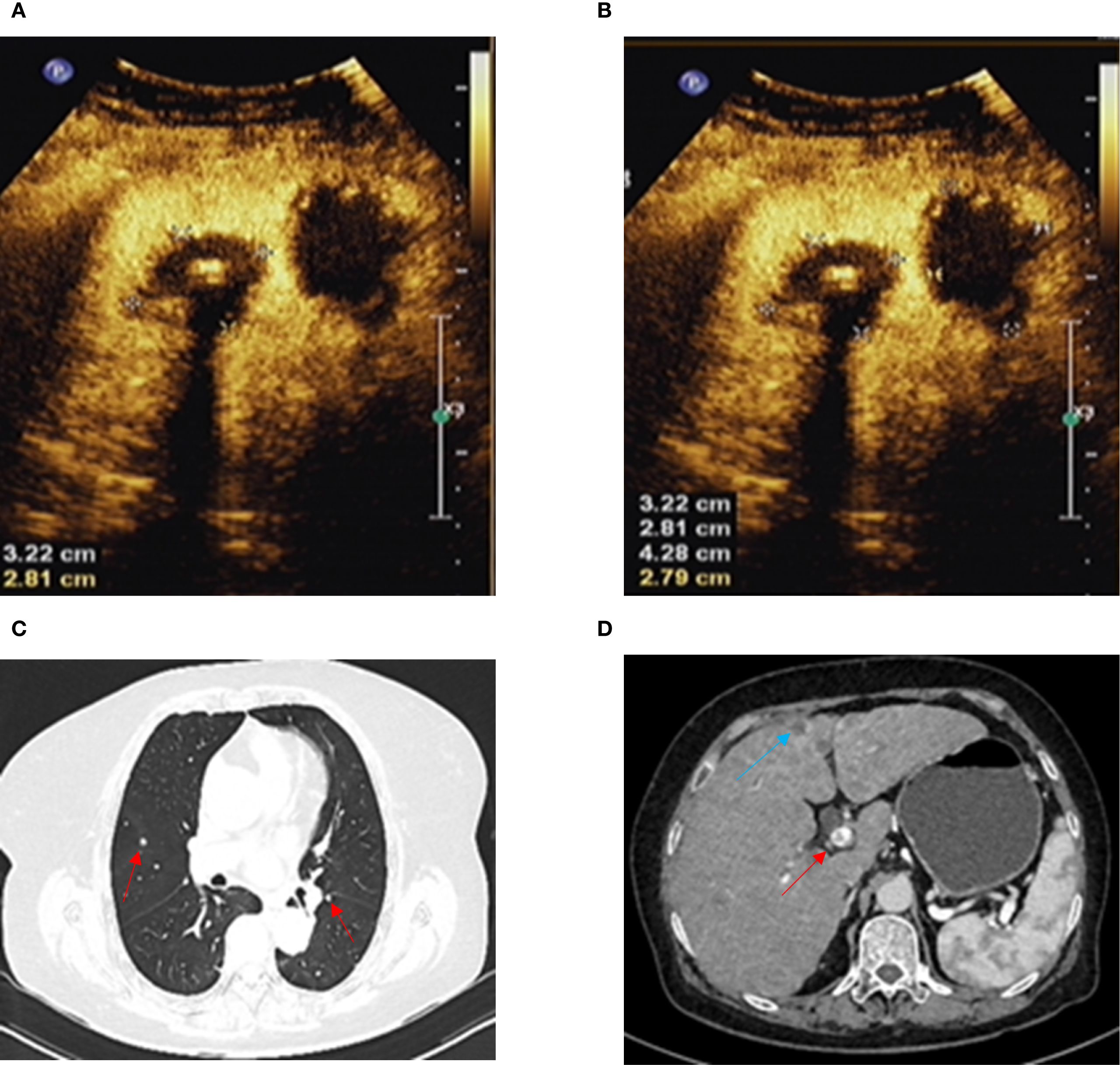 Panel A and B show ultrasound images with measurements indicating a mass. Panel C is a CT scan of the chest, highlighting nodules in both lungs indicated by red arrows. Panel D is a CT scan of the abdomen, showing abnormalities with red and blue arrows indicating specific areas of interest.
