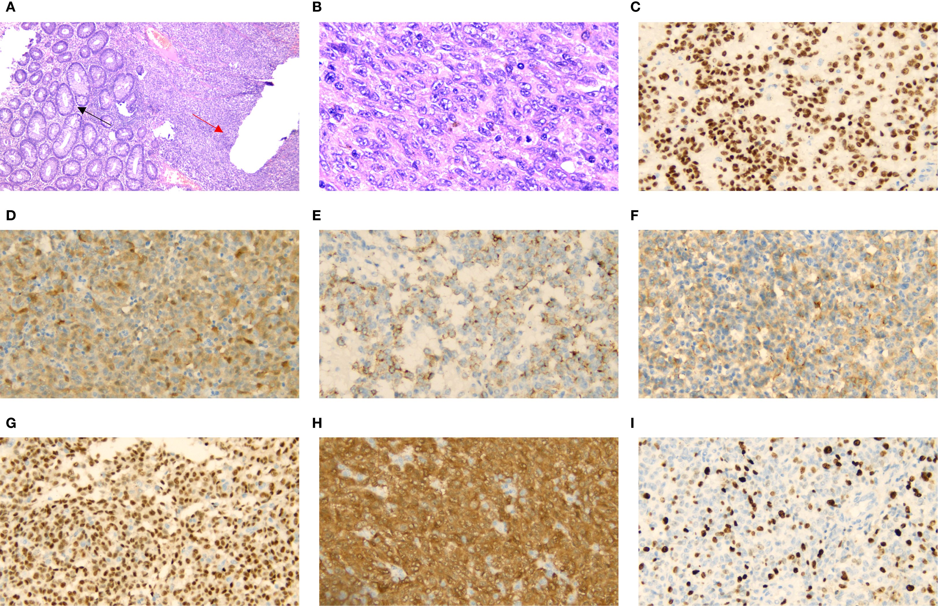 Nine microscopic images labeled A to I display various tissue samples with staining techniques. Image A shows a contrast between healthy and affected tissue, indicated by arrows. Image B highlights cellular details with intense color staining. Image C through I display various staining patterns, indicated by brown and blue coloration of nuclei and cell structures, highlighting different levels of protein expression or cellular activity. These images likely support histological analysis for medical research or diagnostics.