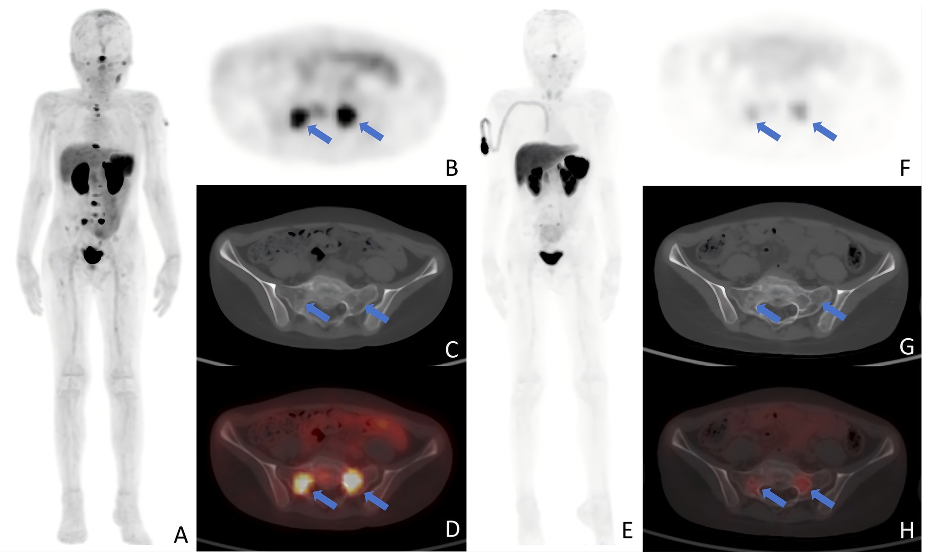 Medical imaging showcases PET and CT scans. Image A and E display full-body scans. Images B, C, D, F, G, and H provide close-ups of the pelvic region, highlighting specific regions with arrows. In panels A-D, dark regions indicate radiotracer uptake in a sacral metastasis. Panels E-H show a decreased uptake after PRRT. This highlights the patient's response to therapy.