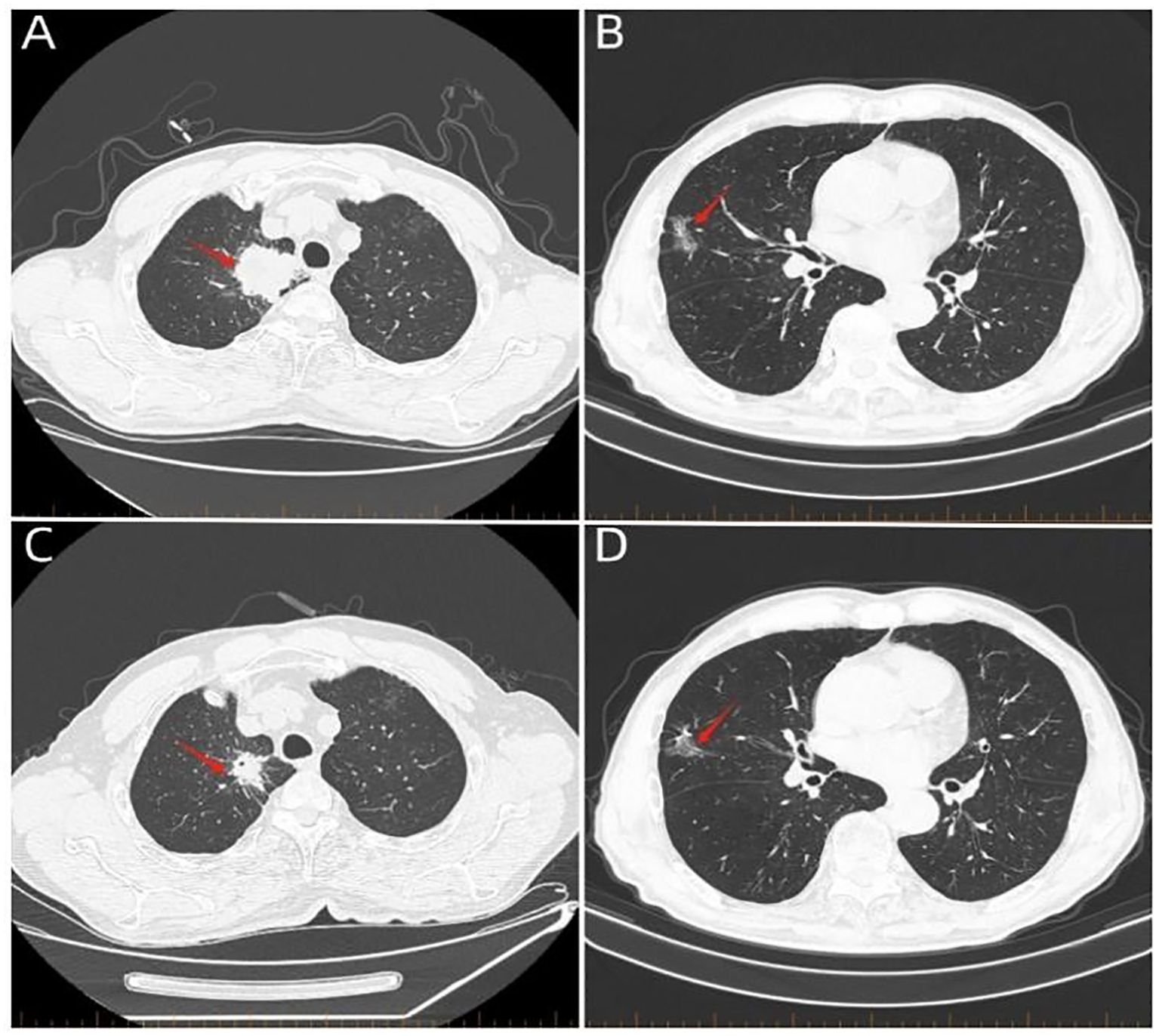 Four-panel image of CT scans showing lung cross-sections. Panel A and C highlight a nodule in the left lung with a red arrow, indicating a specific area of interest. Panels B and D depict a similar area in a different lung section, also marked with a red arrow.