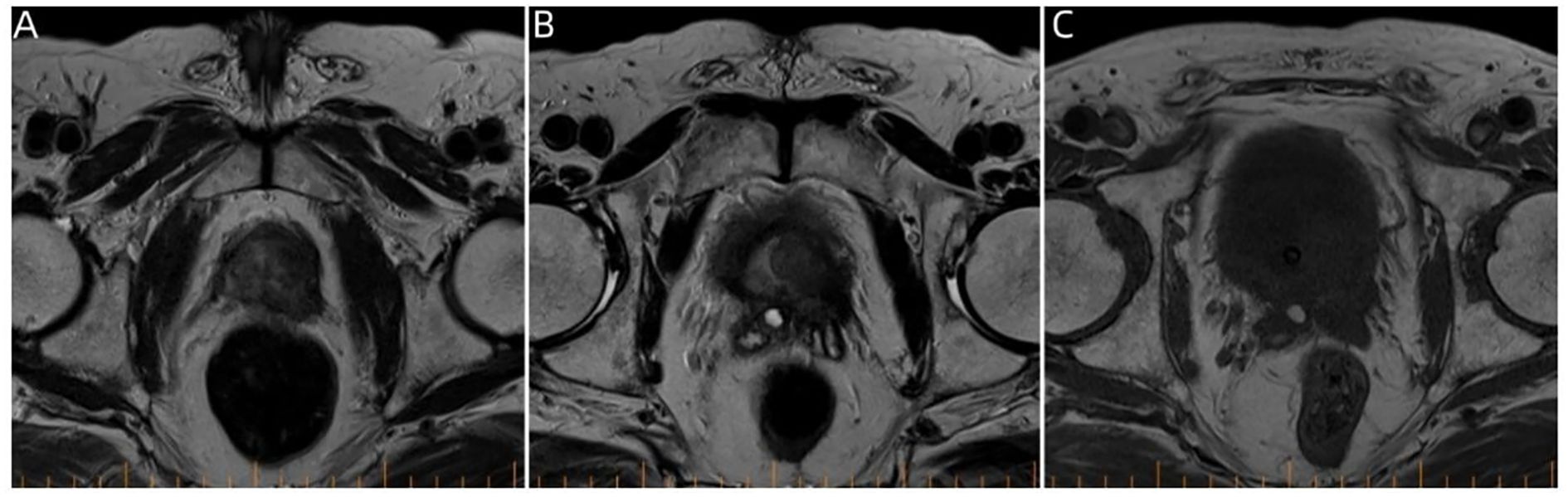 Three-panel MRI images labeled A, B, and C show axial cross-sections of a pelvic region. Each panel highlights variations in tissue density, with distinct dark and light areas representing different anatomical structures.
