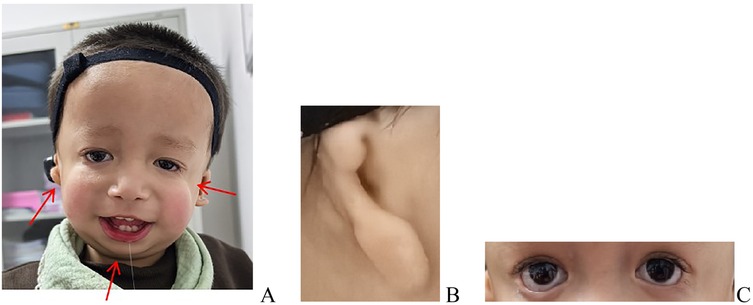 Clinical photograph of a pediatric patient with dysmorphic features. Panel A: Frontal view showing downslanting palpebral fissures, depressed nasal bridge, malar and mandibular hypoplasia, with arrows highlighting these features and the ears. Panel B: Close-up lateral view of the right microtia. Panel C: Close-up of the eyes highlighting downslanting palpebral fissures and depressed nasal bridge.