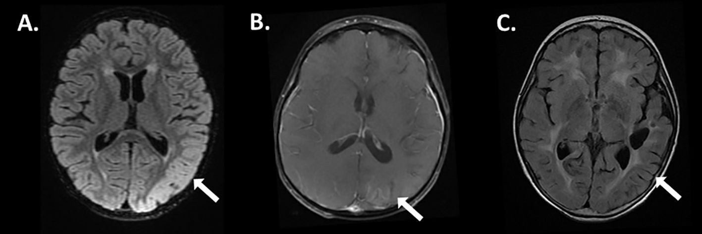 MRI brain scans labeled A, B, and C show axial sections. Each image highlights a specific area with an arrow, indicating areas of interest or abnormalities in the brain tissue. Images display variations in brain structure intensity and detailing.