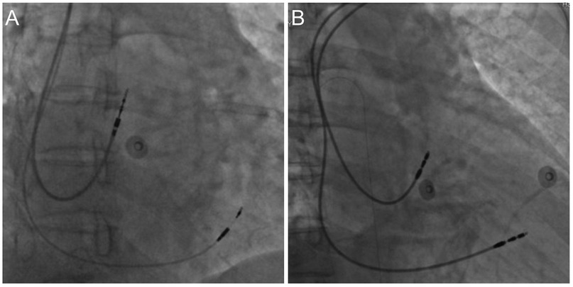 Two X-ray images labeled A and B show catheter placement in the chest area. Image A features one catheter, while image B shows two catheters positioned in the body. The images are likely part of a medical procedure or study.