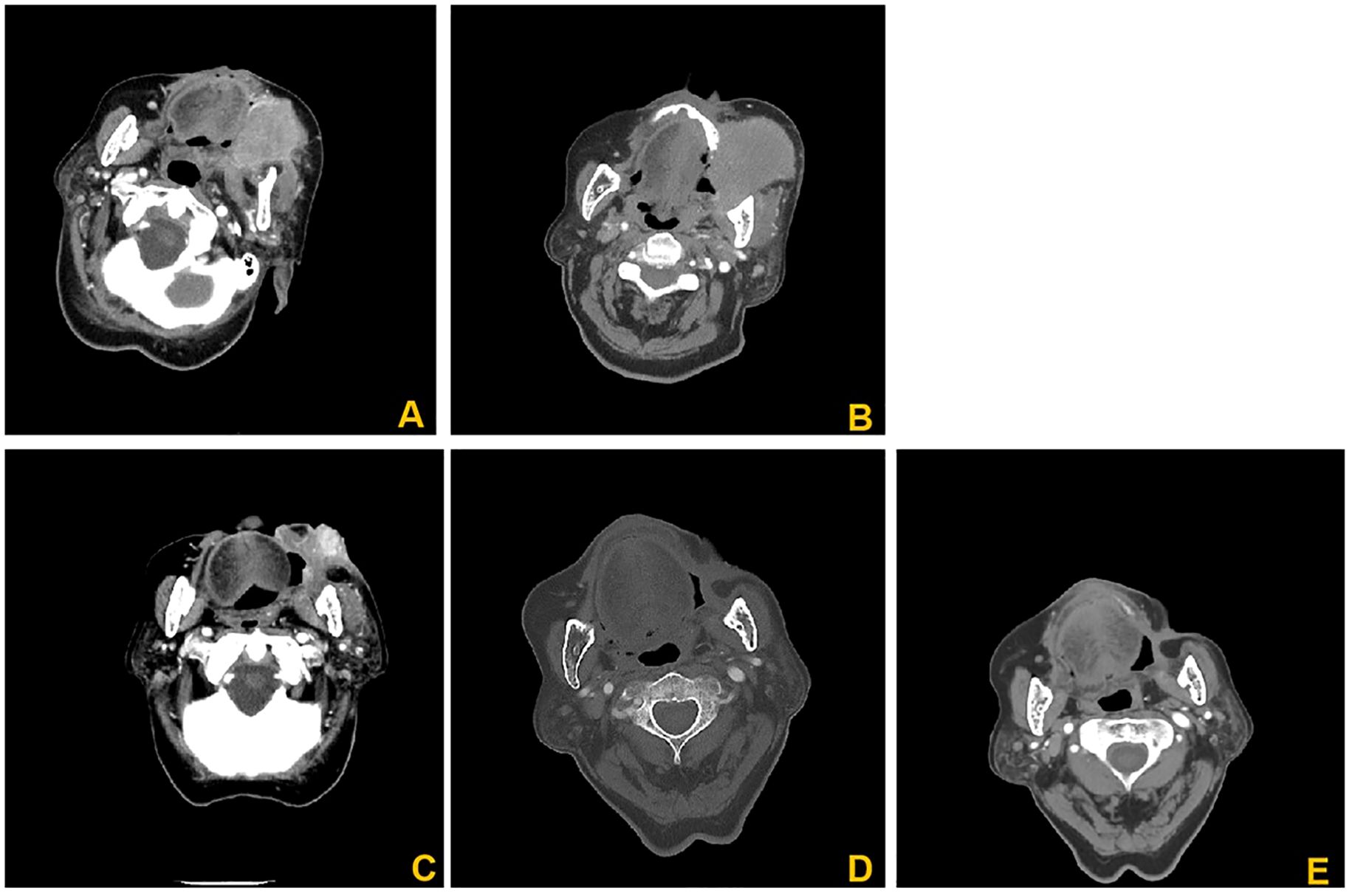 CT scans in five panels labeled A to E show axial cross-sections of a head and neck region. Each panel reveals varying soft tissue densities, bone structures, and air spaces, highlighting anatomical differences in the region.