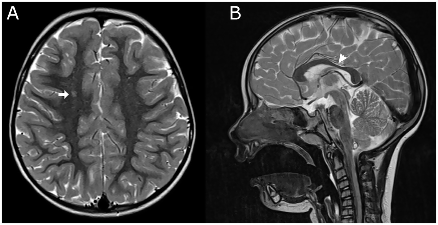 MRI images showing brain sections. Image A: Axial view with an arrow indicating a specific region of interest on one hemisphere. Image B: Sagittal view with an arrow pointing to a part of the brain's midline structure.