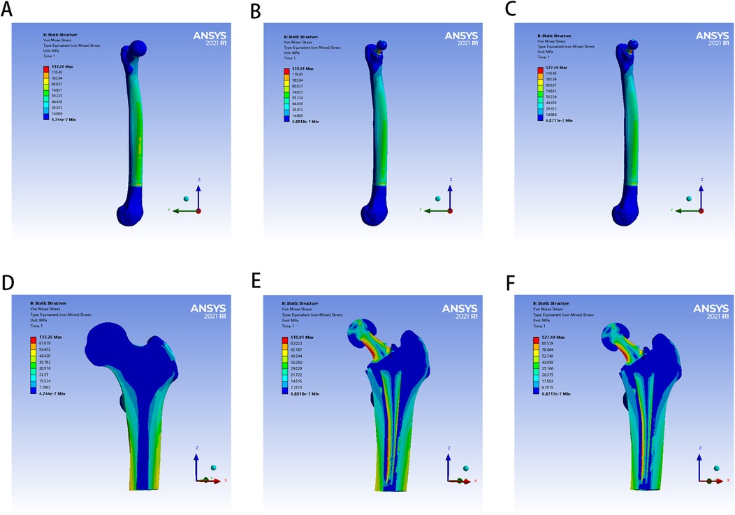 Six simulations display von Mises stress on femur models, labeled A to F, using ANSYS 2021. Each model shows a color gradient scale, where red indicates maximum stress and blue indicates minimum. The orientation varies, with some images focusing on specific regions like the femoral head (D, E, F). Axes are labeled X, Y, Z for reference.