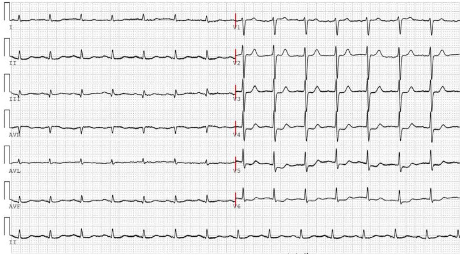 Electrocardiogram (ECG) showing multiple leads with waveforms indicating heart activity. Leads I, II, III, AVR, AVL, AVF, and V1 to V6 are labeled, displaying regular PQRST intervals.