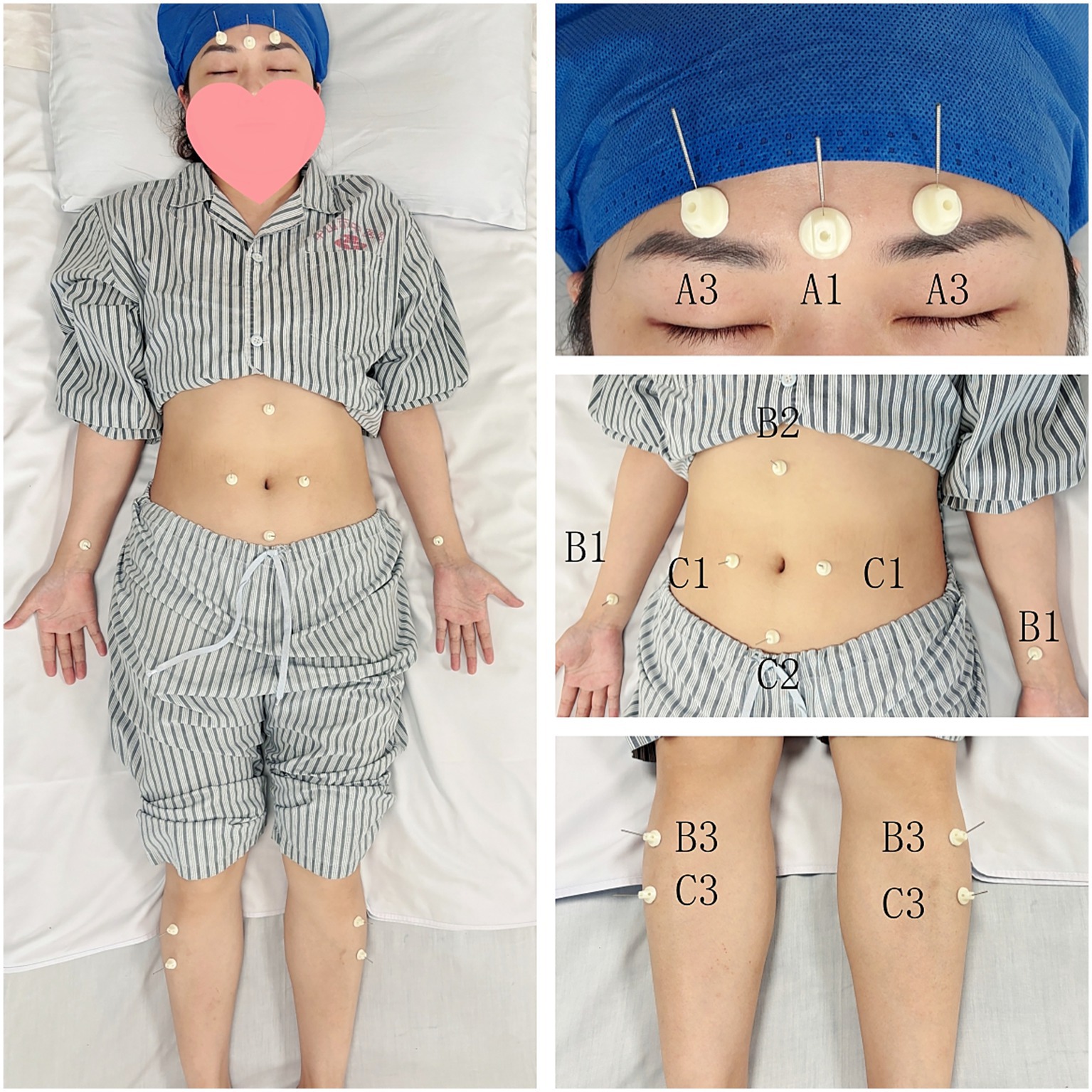 Person lying on a bed wearing striped pajamas. Acupuncture needles with labels are placed on the forehead (A1, A3), abdomen (B1, B2, C1, C2), and legs (B3, C3).