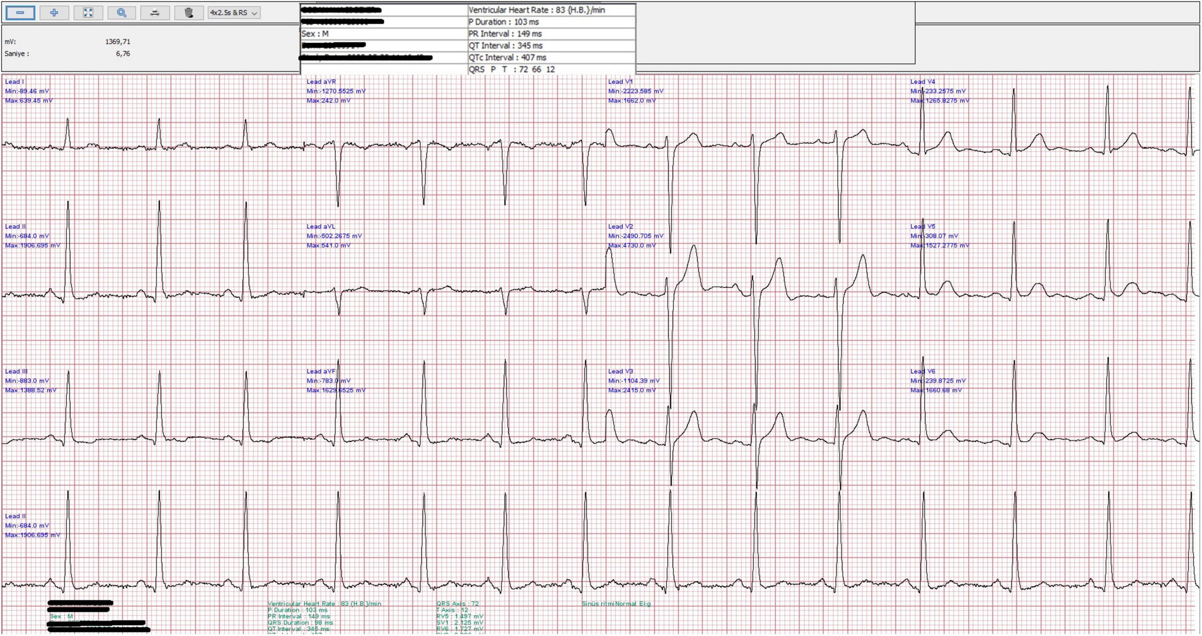 ECG tracing showing multiple leads with heart rate of 83 beats per minute. Measurements include a PR interval of 186 milliseconds, QRS duration of 72 milliseconds, and QT interval of 407 milliseconds. Regular sinus rhythm with consistent waveform patterns is visible across all leads.