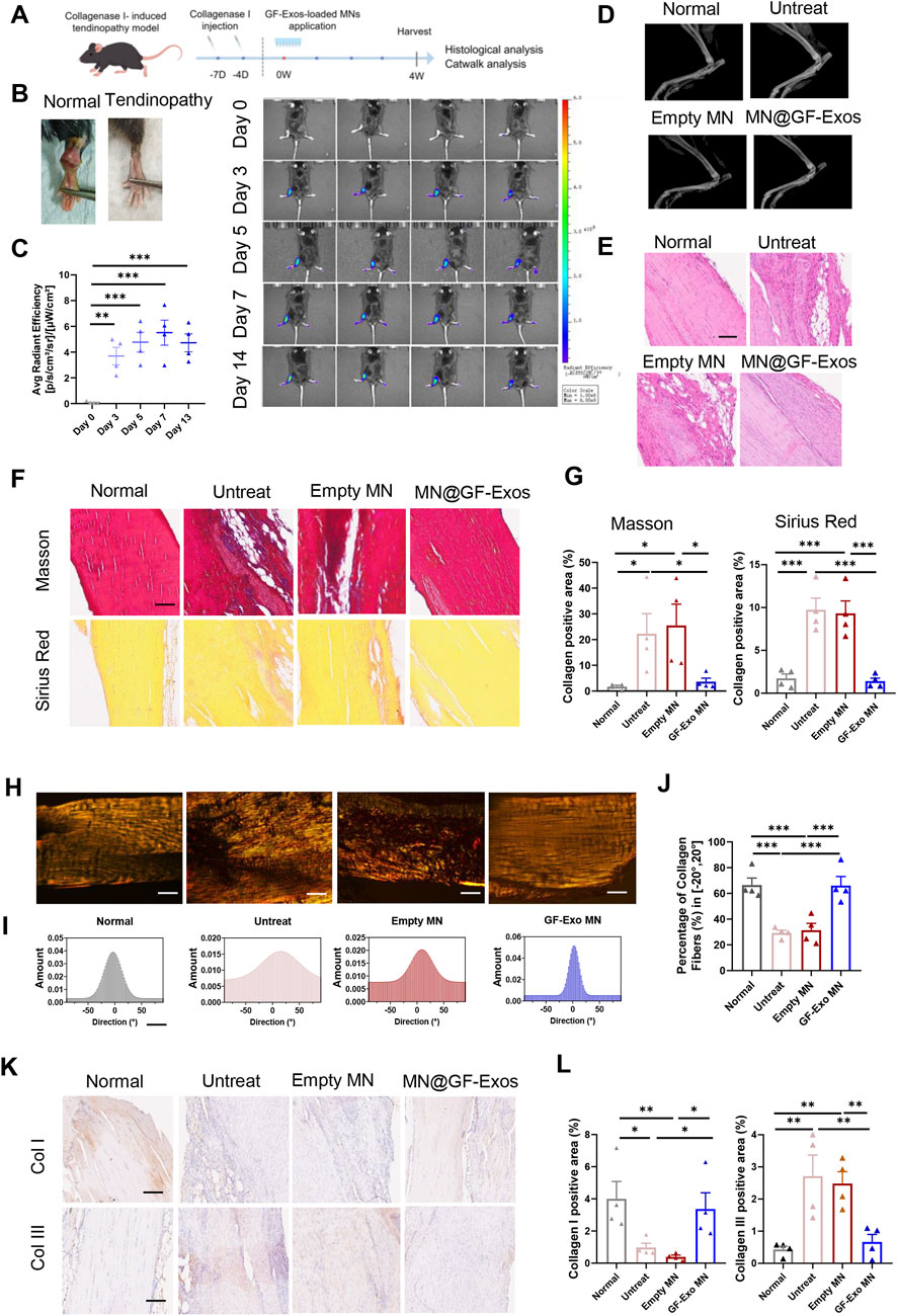 A series of diagrams and graphs illustrating a study on collagenase-induced tendinopathy and the effects of GF-Exos-loaded microneedles (MN). (A) Timeline of the experimental procedure. (B) Images of tendinopathy progression over time. (C) Graph showing radiant efficiency data. (D) Ultrasound images depicting normal, untreated, empty MN, and MN@GF-Exos-treated tendons. (E) Histological sections with different treatments. (F) Masson and Sirius Red stained sections showing collagen. (G) Charts comparing collagen-positive areas. (H) Polarized light images highlighting fiber orientation. (I) Graphs of collagen fiber directions. (J) Bar graph of collagen fibers' percentage. (K) Immunohistochemistry images for collagen types I and III. (L) Bar graphs comparing collagen type I and III positive areas.