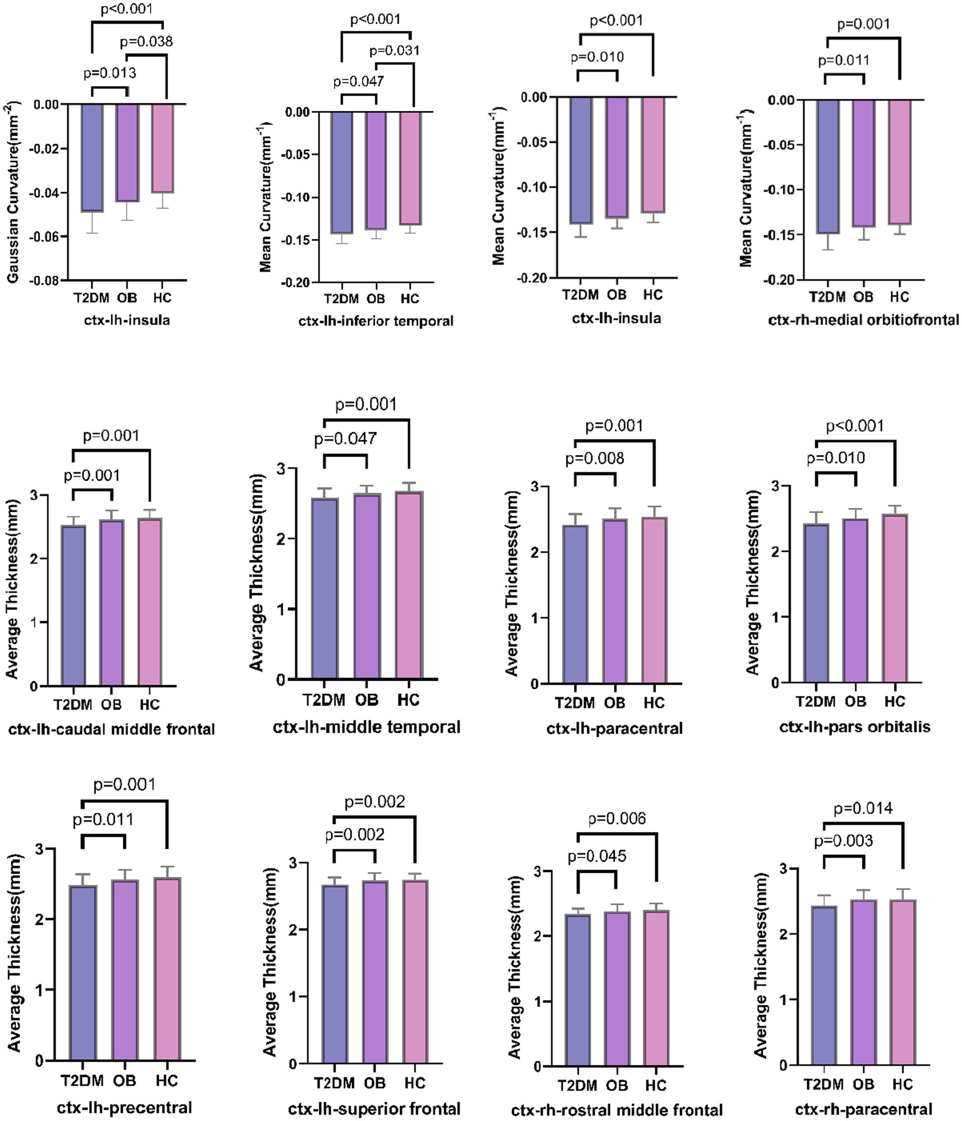 Bar graphs showing differences in Gaussian curvature and average thickness across various brain regions for groups labeled T2DM, OB, and HC. Each panel displays statistical significance with p-values, indicating differences between the groups in specific regions such as the insula, caudal middle frontal, and rostral middle frontal. The bars are colored in blue for T2DM, purple for OB, and pink for HC, with error bars denoting variability.